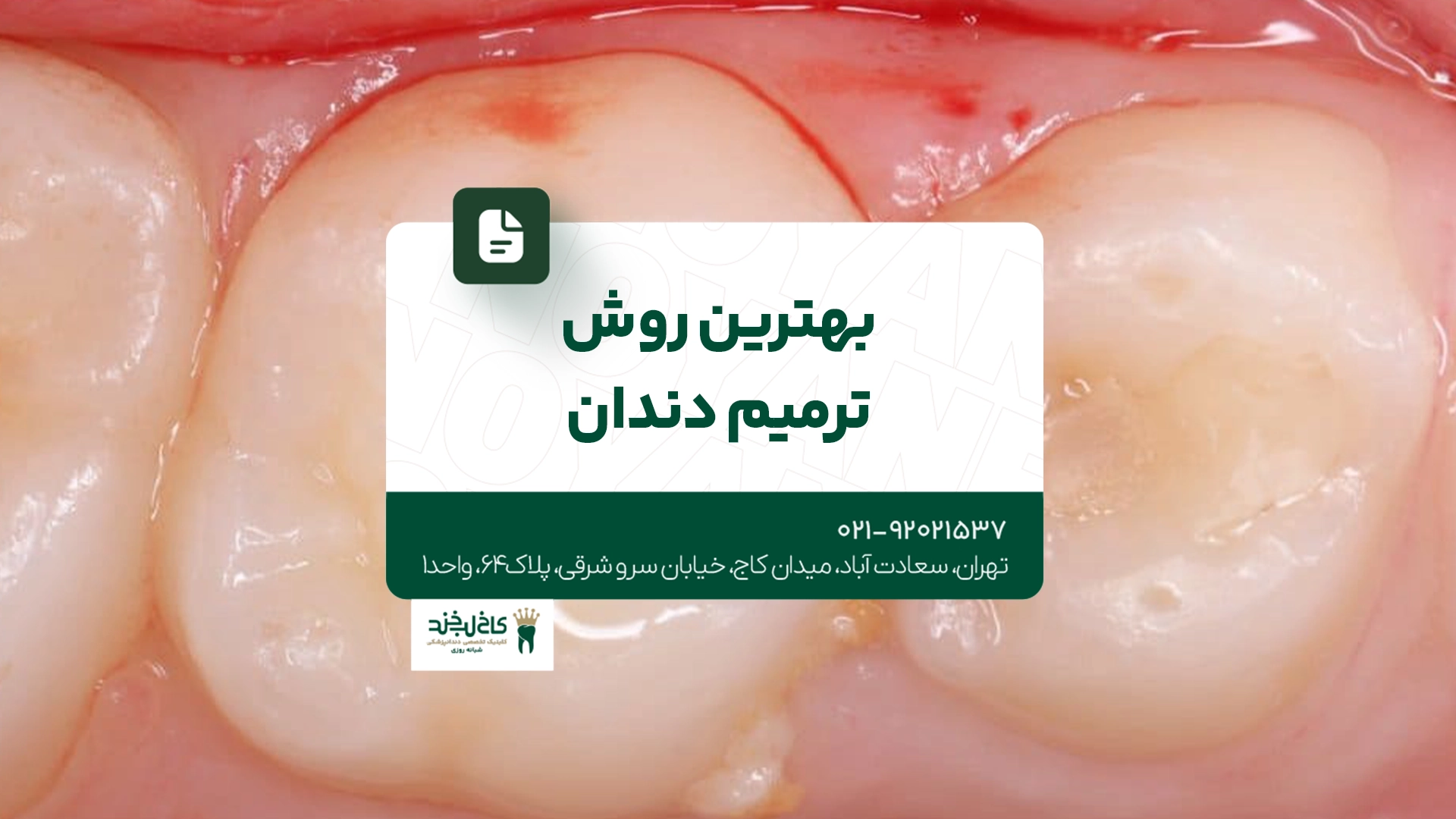 بهترین روش ترمیم دندان