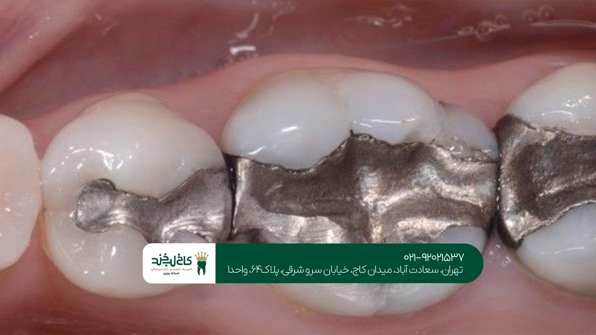 چگونه ماندگاری ترمیم دندان را افزایش دهیم؟