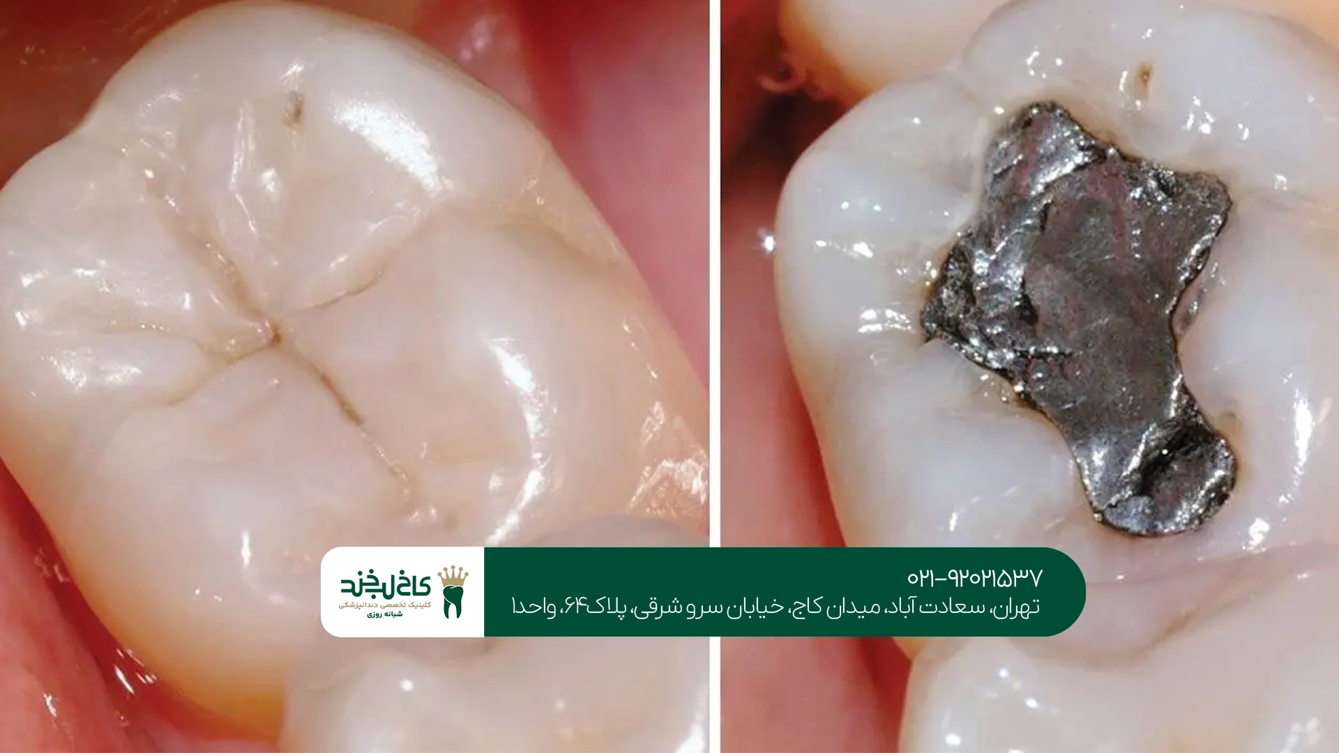 عوامل مؤثر در انتخاب بهترین روش ترمیم دندان