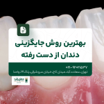 بهترین روش جایگزینی دندان از دست رفته