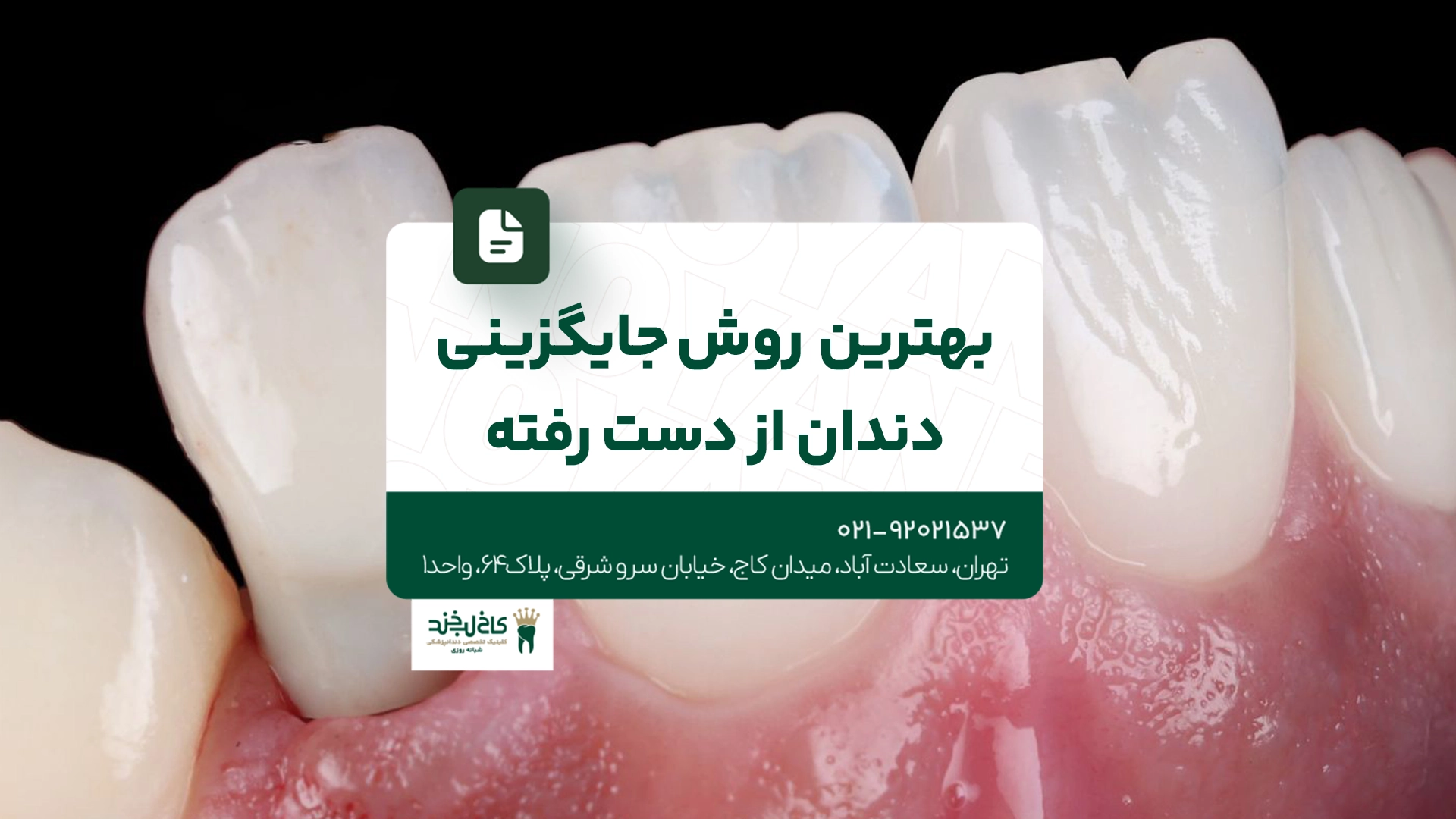بهترین روش جایگزینی دندان از دست رفته بهترین روش جایگزینی دندان از دست رفته