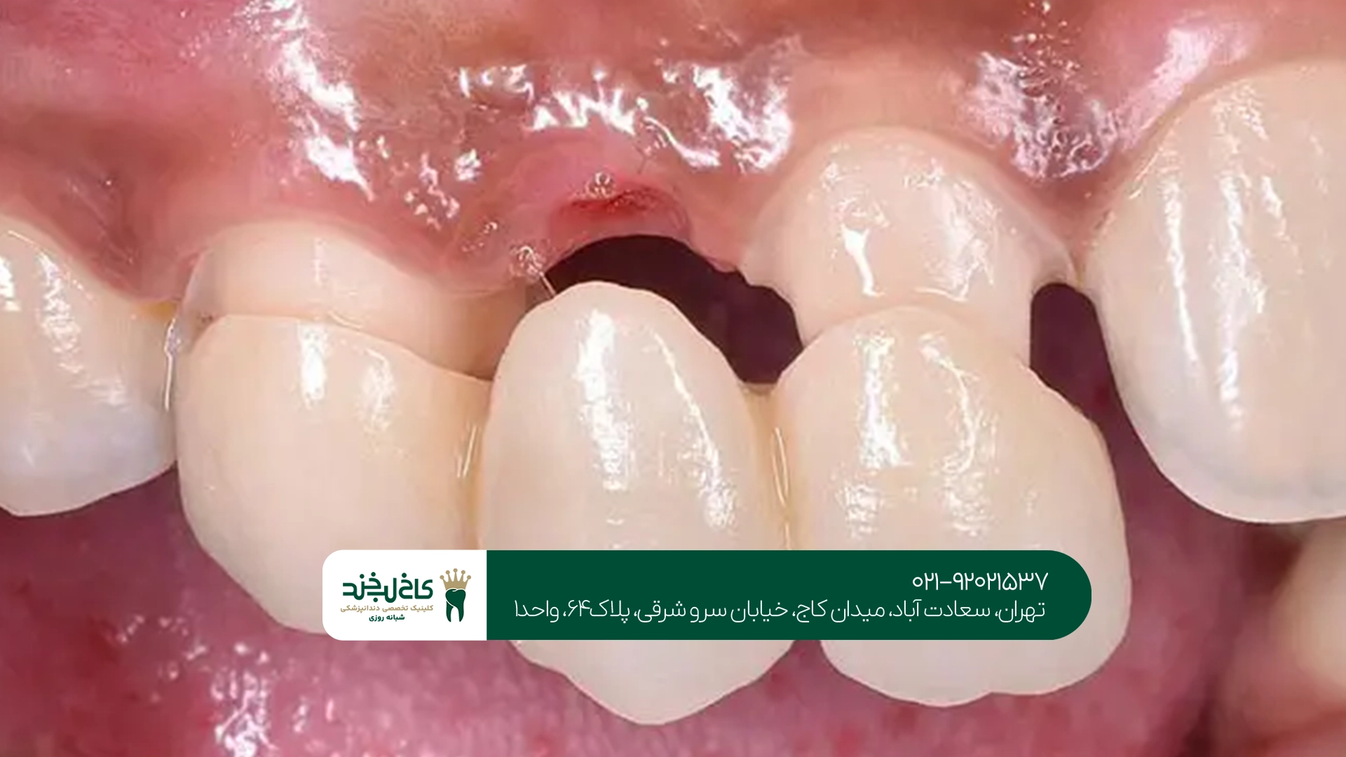ایمپلنت یا بریج ؟ ایمپلنت یا بریج ؟
