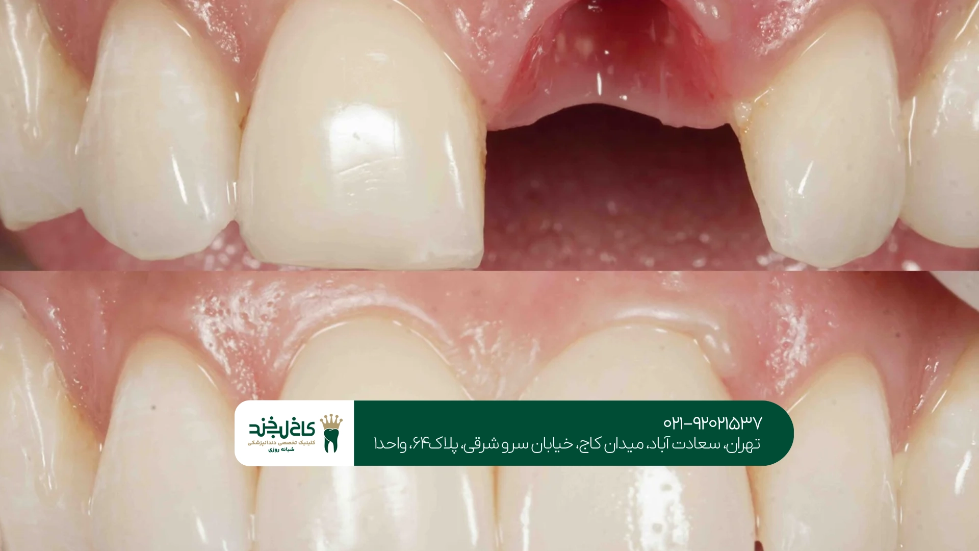 مزایا و معایب روشهای جایگزینی دندان مزایا و معایب روشهای جایگزینی دندان