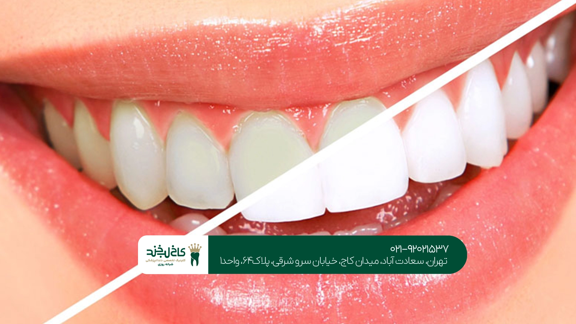 رزرو نوبت سفید کردن دندان