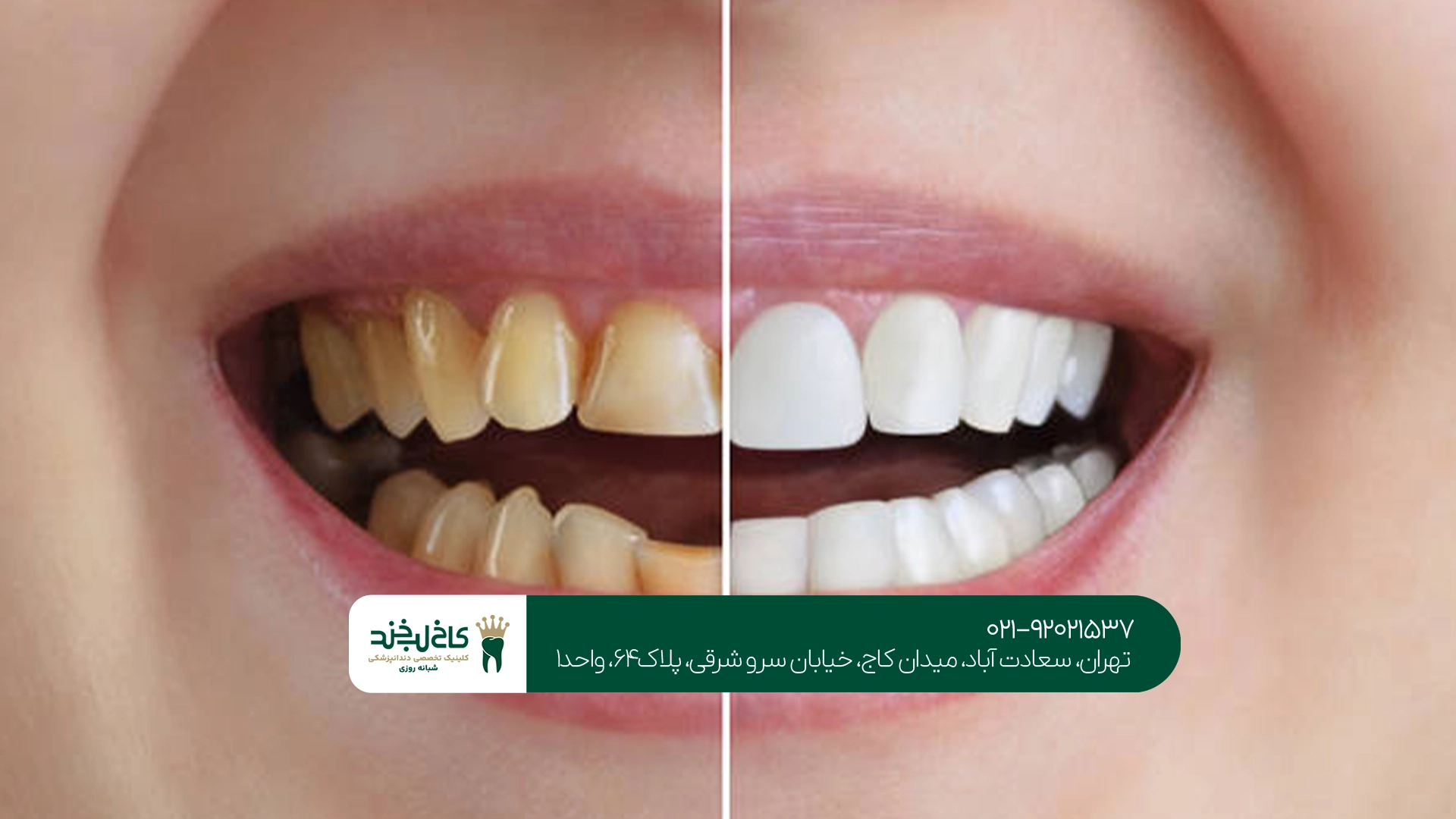 سفید کردن دندان در تهران