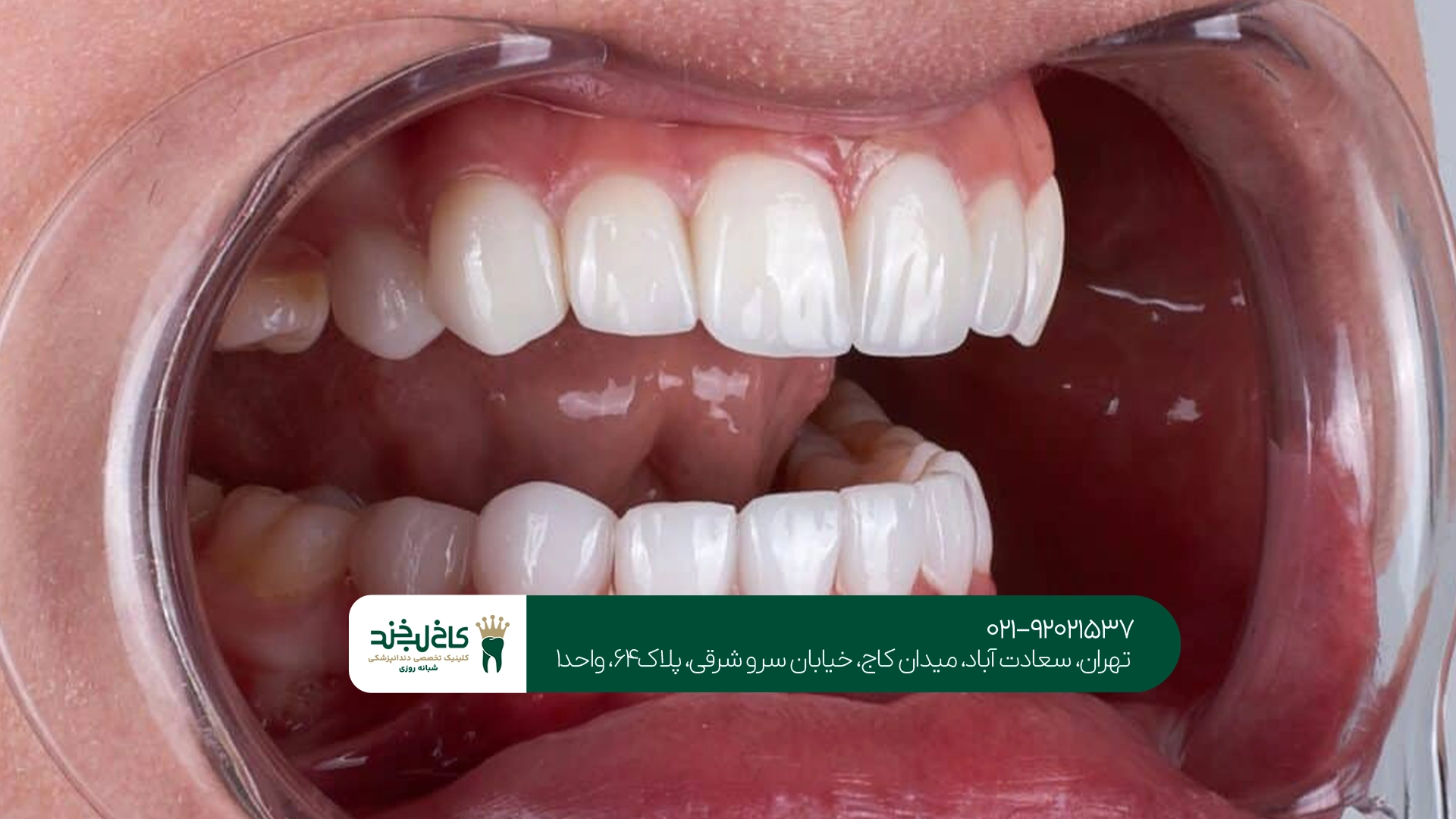بلیچینگ دندان بهتر است یا روشهای خانگی؟