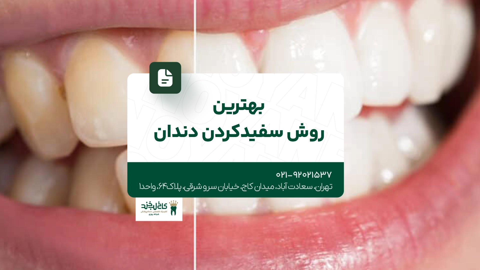 بهترین روش سفید کردن دندان