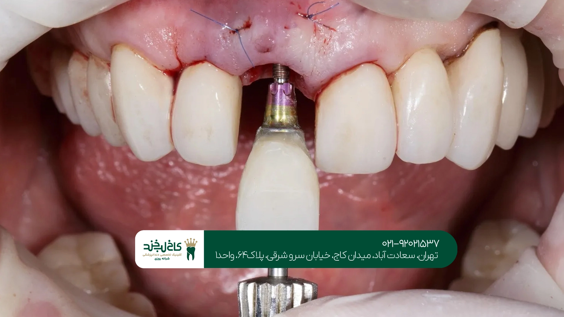 چرا تجربه متخصص ایمپلنت در موفقیت درمان اهمیت دارد؟