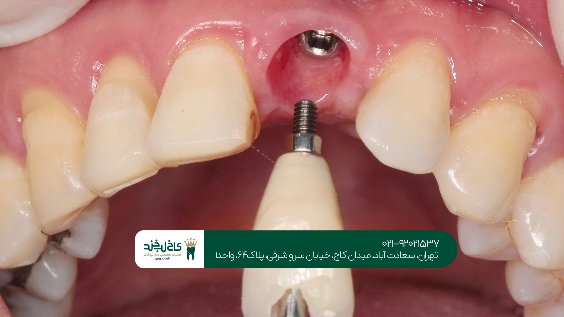 متخصص ایمپلنت تهران