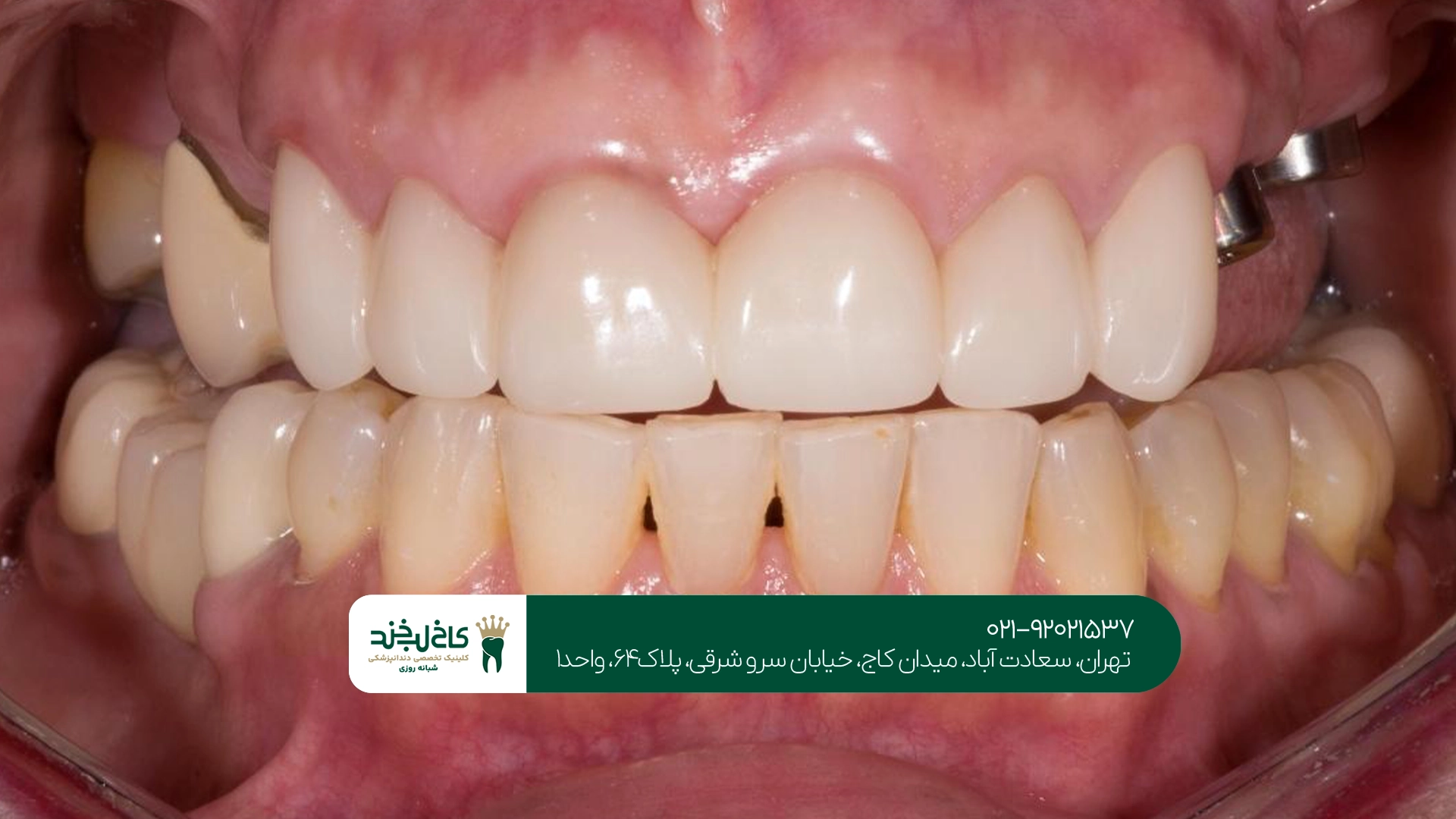بهترین کلینیک ایمپلنت دندان در سعادت آباد