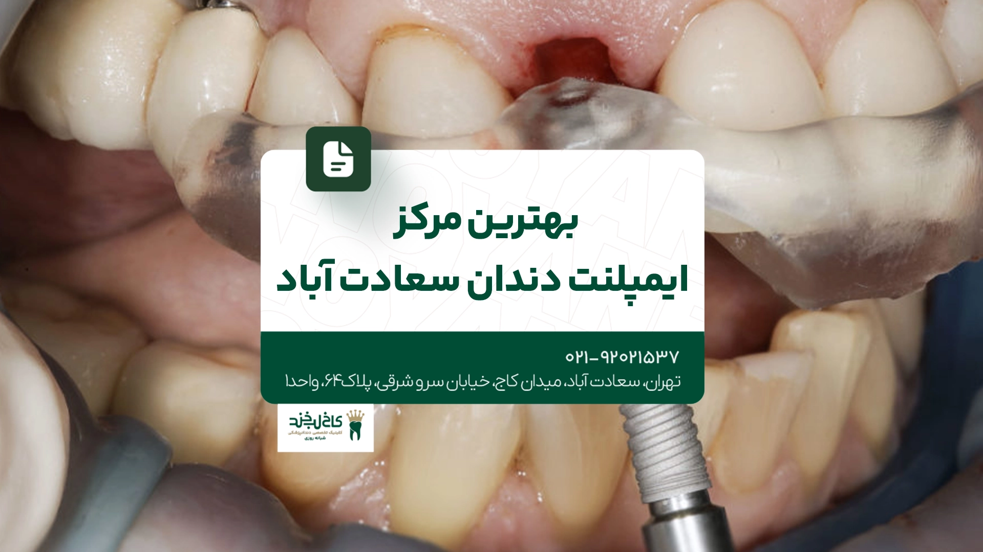 بهترین مرکز ایمپلنت دندان سعادت آباد