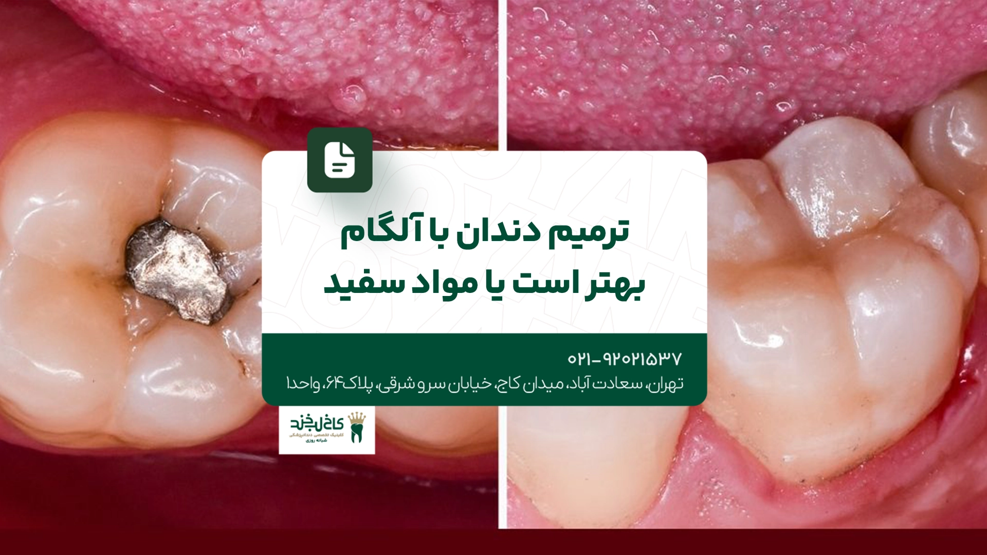 ترمیم دندان با آمالگام بهتر است یا مواد سفید