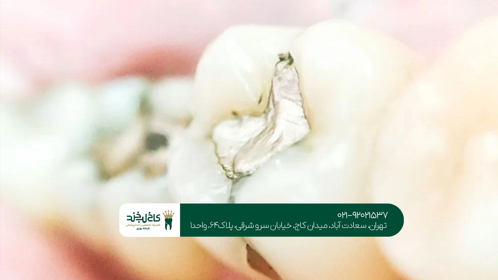 ترمیم دندان با آمالگام چگونه انجام میشود؟