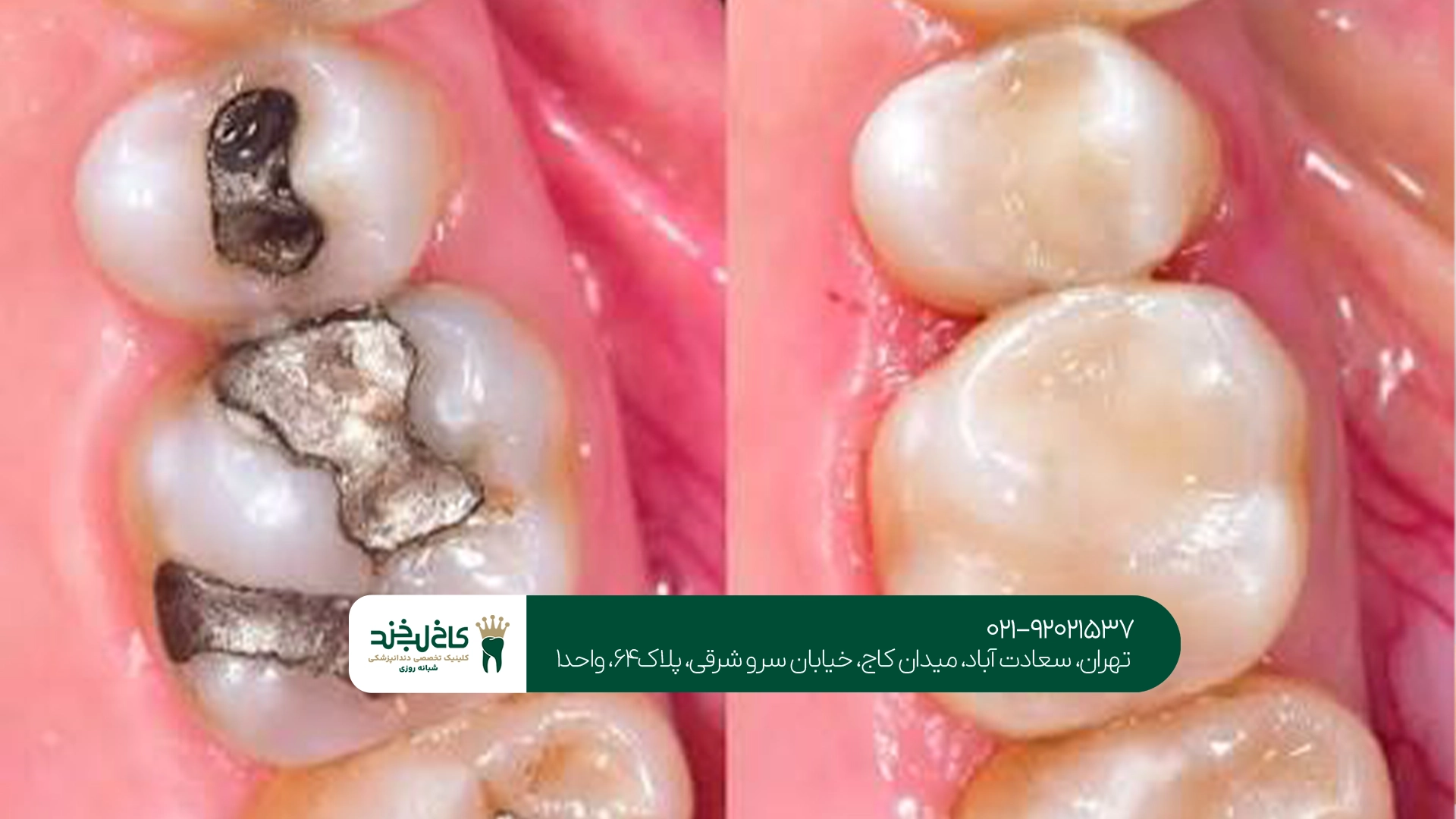 آمالگام و مواد سفید دندان چه تفاوتی دارند؟