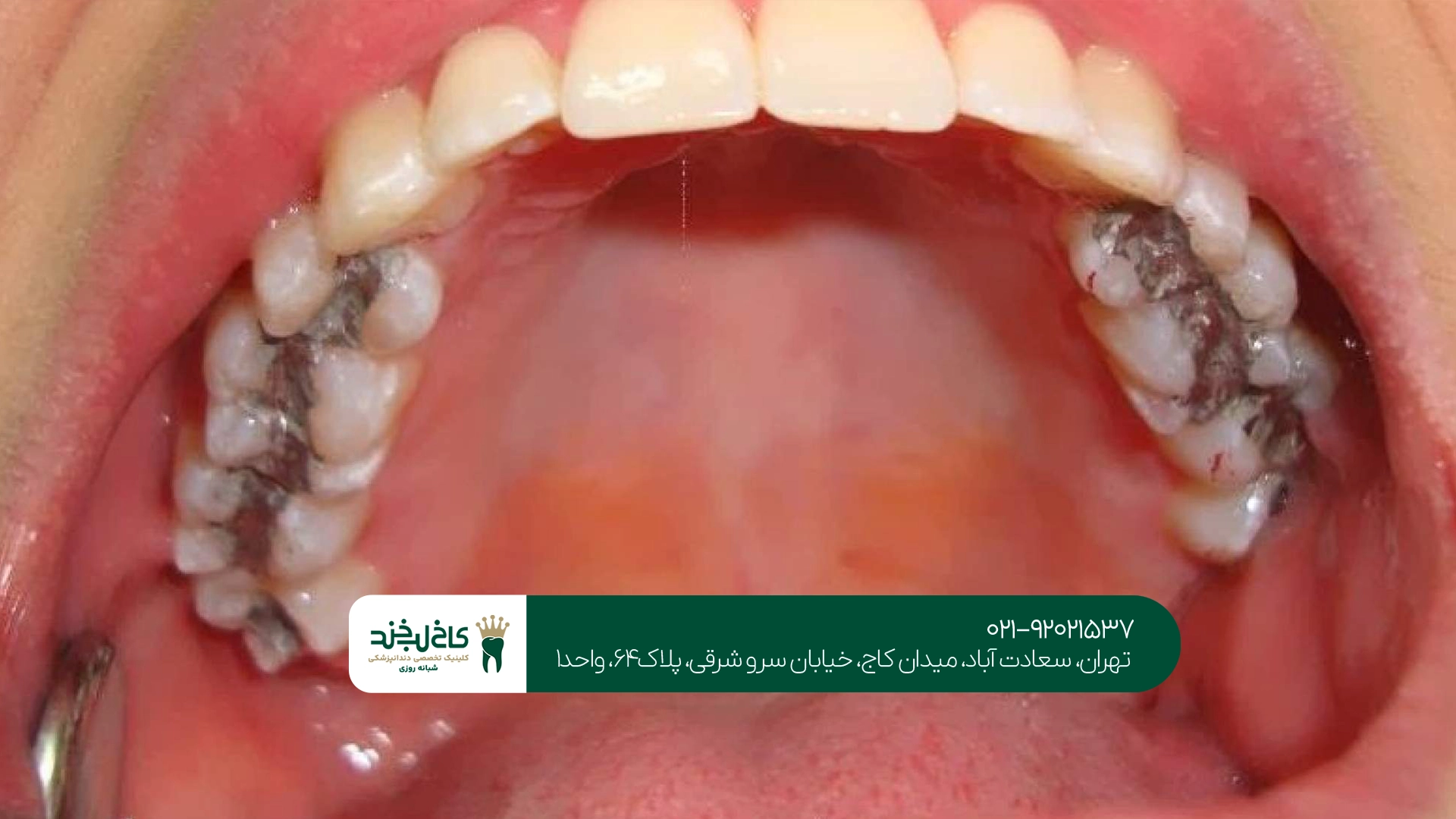 ترمیم دندان تهران ترمیم دندان تهران