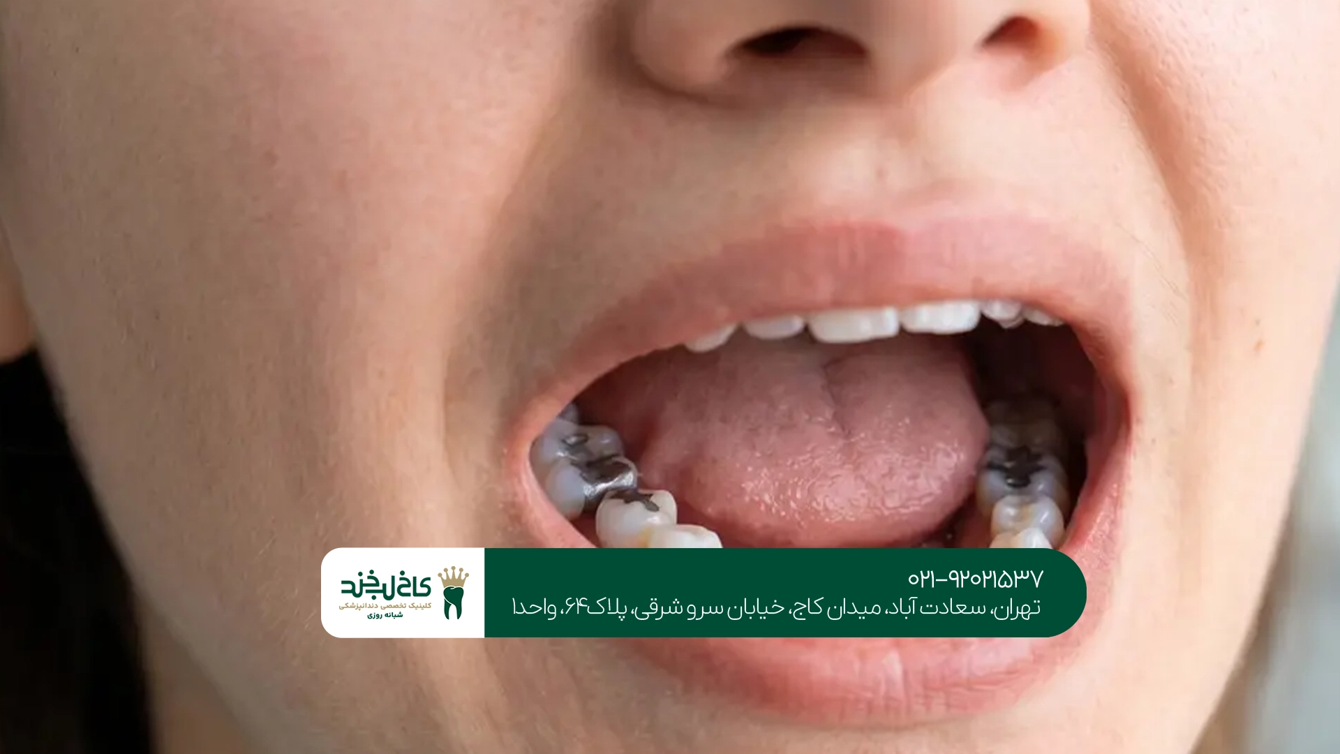 ترمیم دندان در تهران ترمیم دندان در تهران