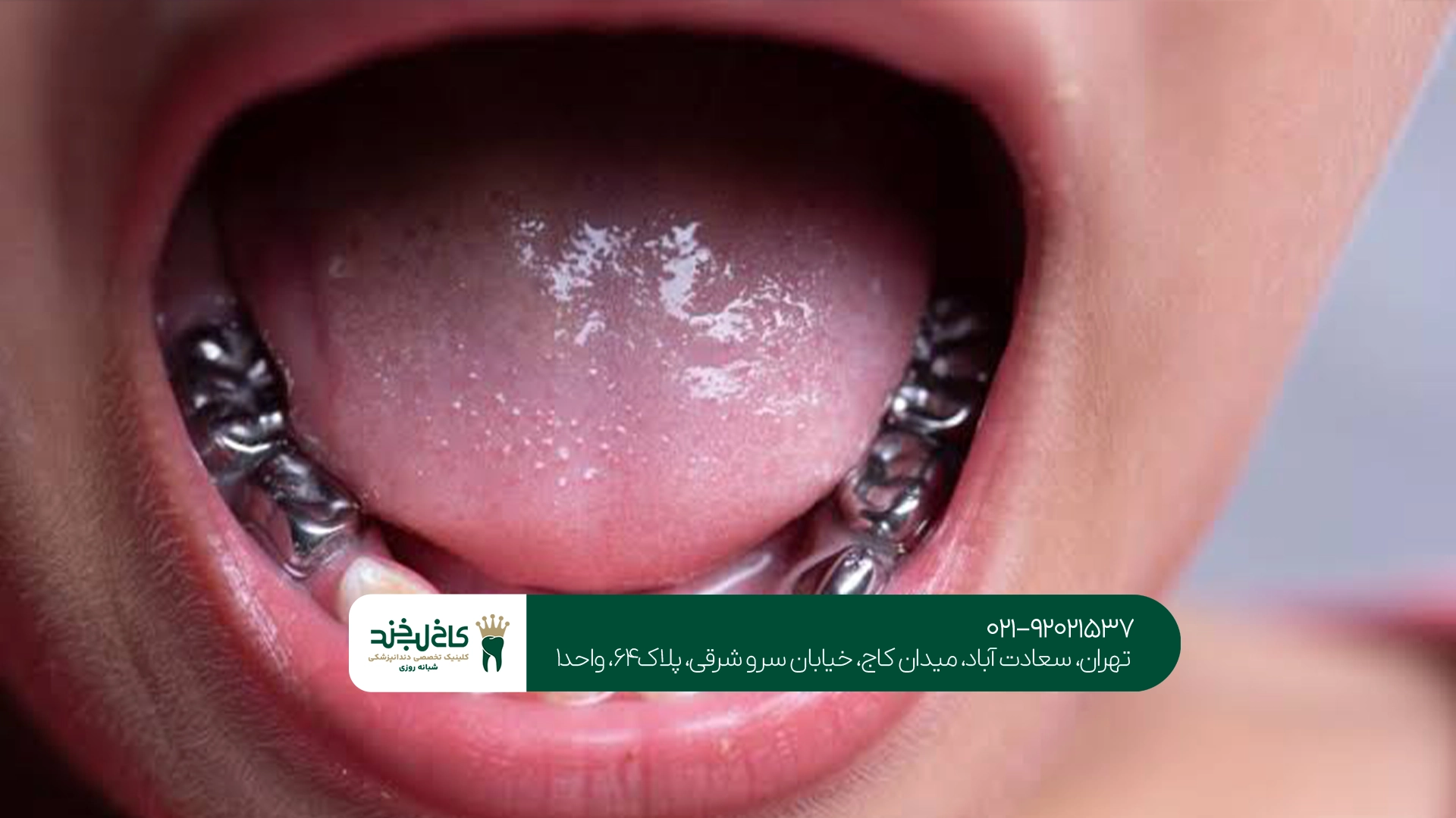 ترمیم دندان ترمیم دندان