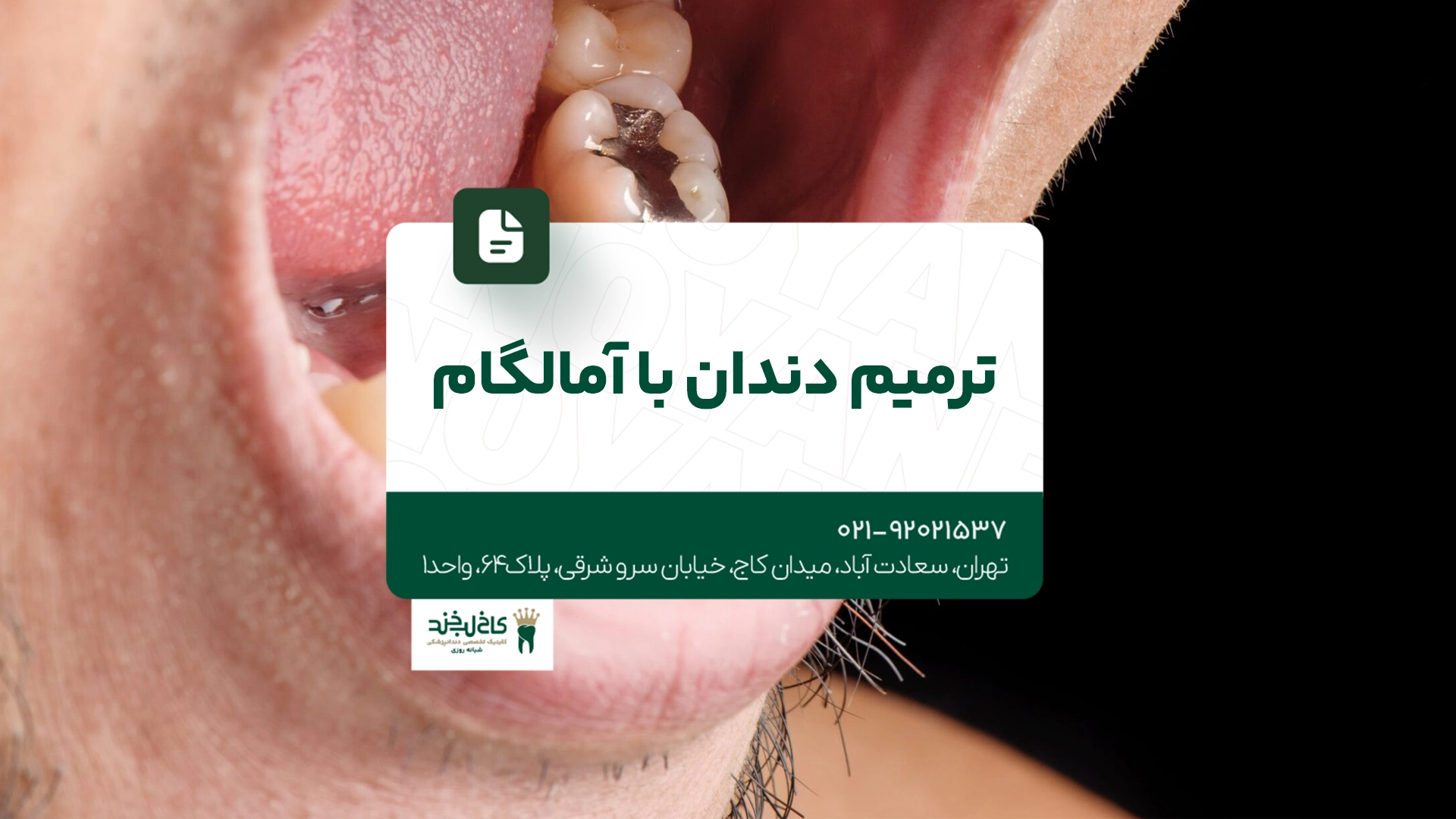 ترمیم دندان با آمالگام ترمیم دندان با آمالگام