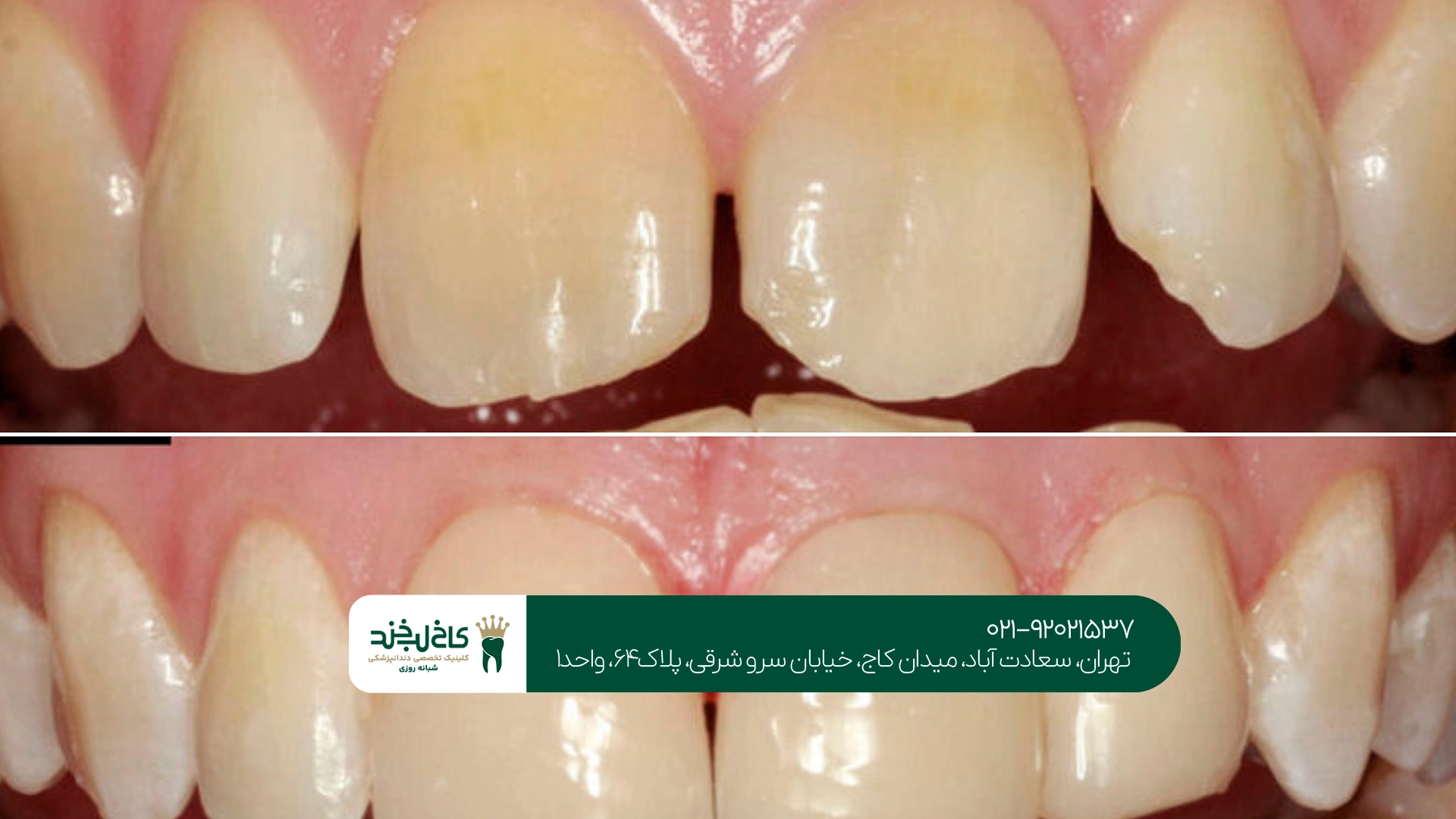 بهترین مرکز ترمیم دندان جلو