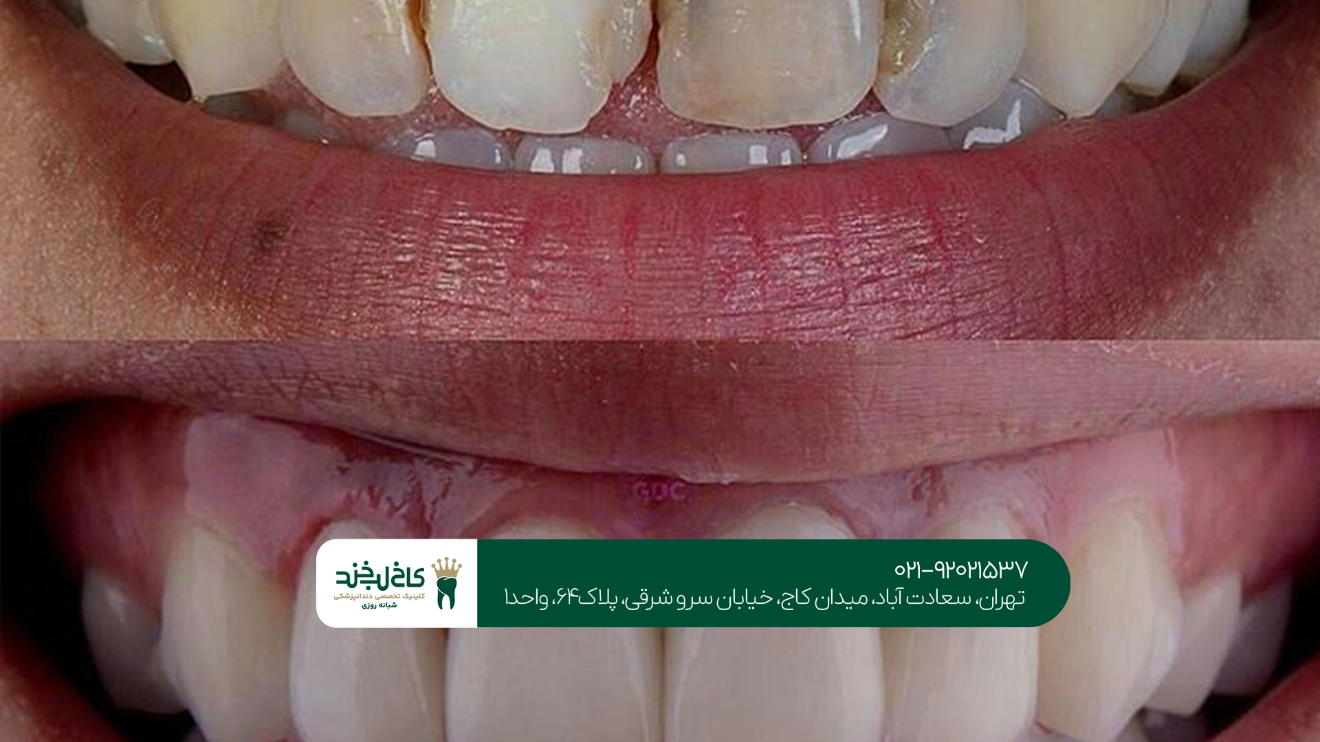 ترمیم دندان جلو با کامپوزیت در تهران