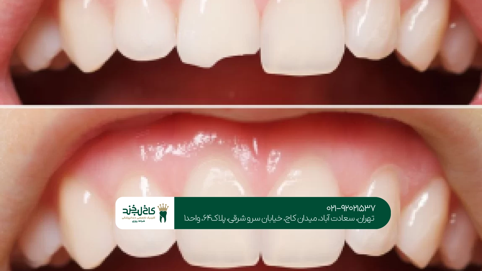مراحل ترمیم دندان جلو با کامپوزیت