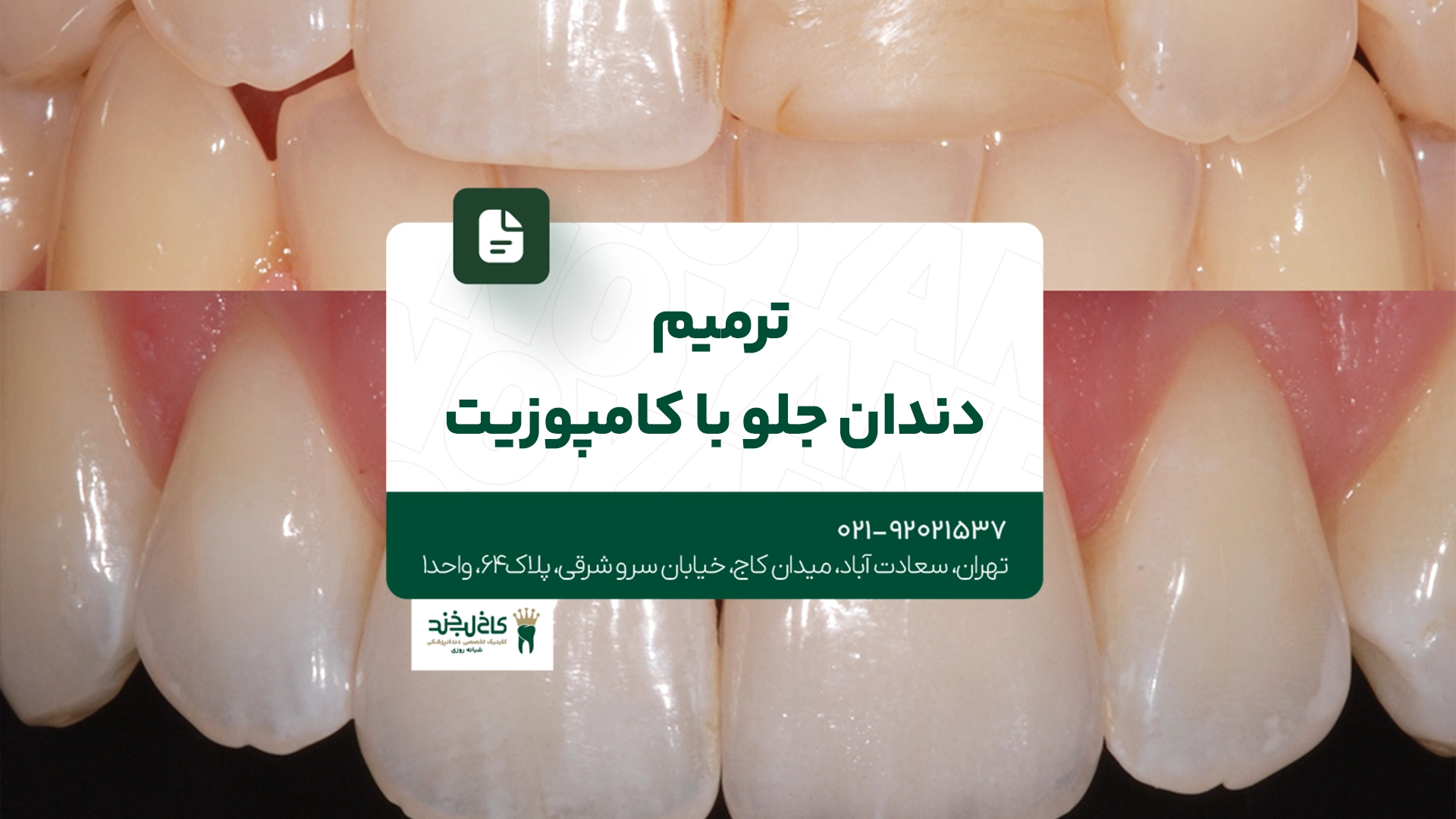 ترمیم دندان جلو با کامپوزیت