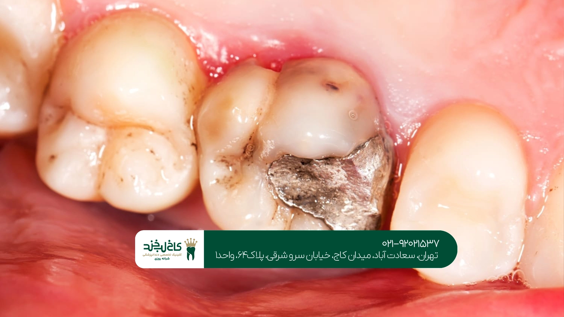 ترمیم دندان پوسیده بدون درد در تهران