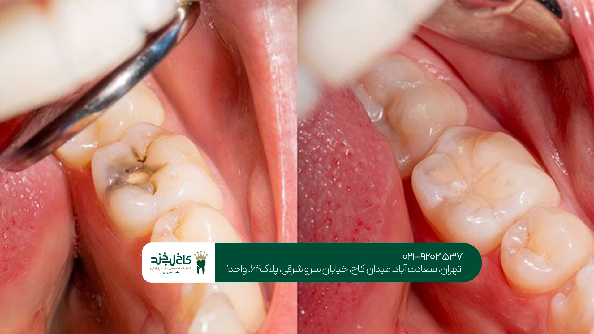 متخصص ترمیم دندان پوسیده در تهران