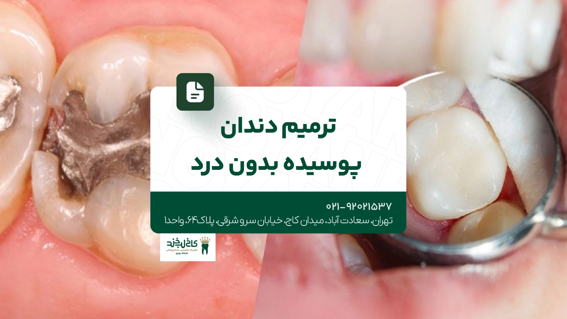 ترمیم دندان پوسیده بدون درد