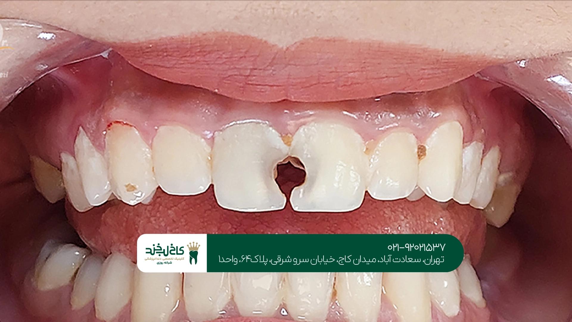 بهترین کلینیک برای ترمیم پوسیدگی بین دندانی