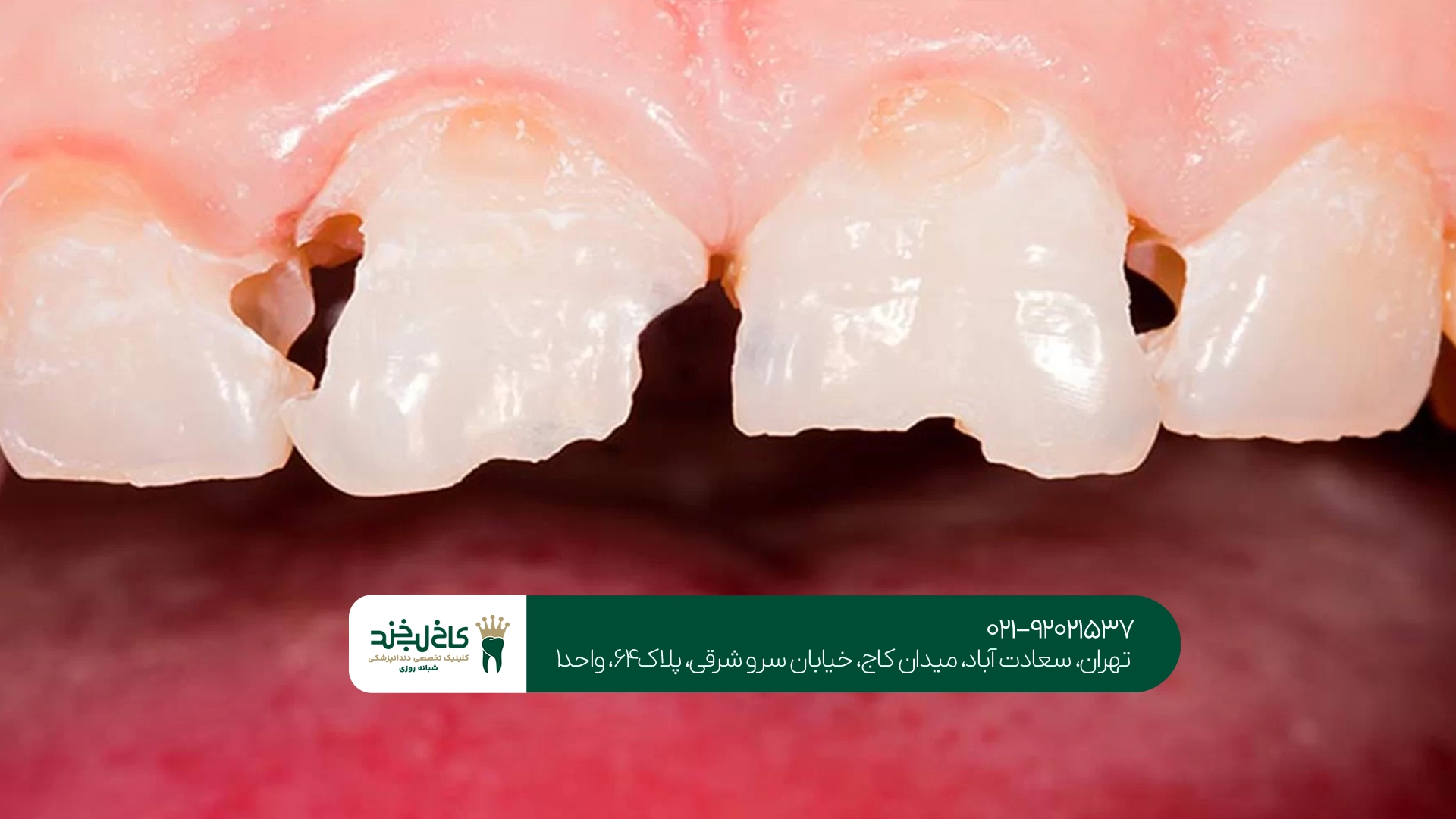 آیا پوسیدگی بین دندانی قابل پیشگیری است