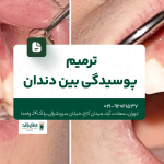 ترمیم پوسیدگی بین دندانی