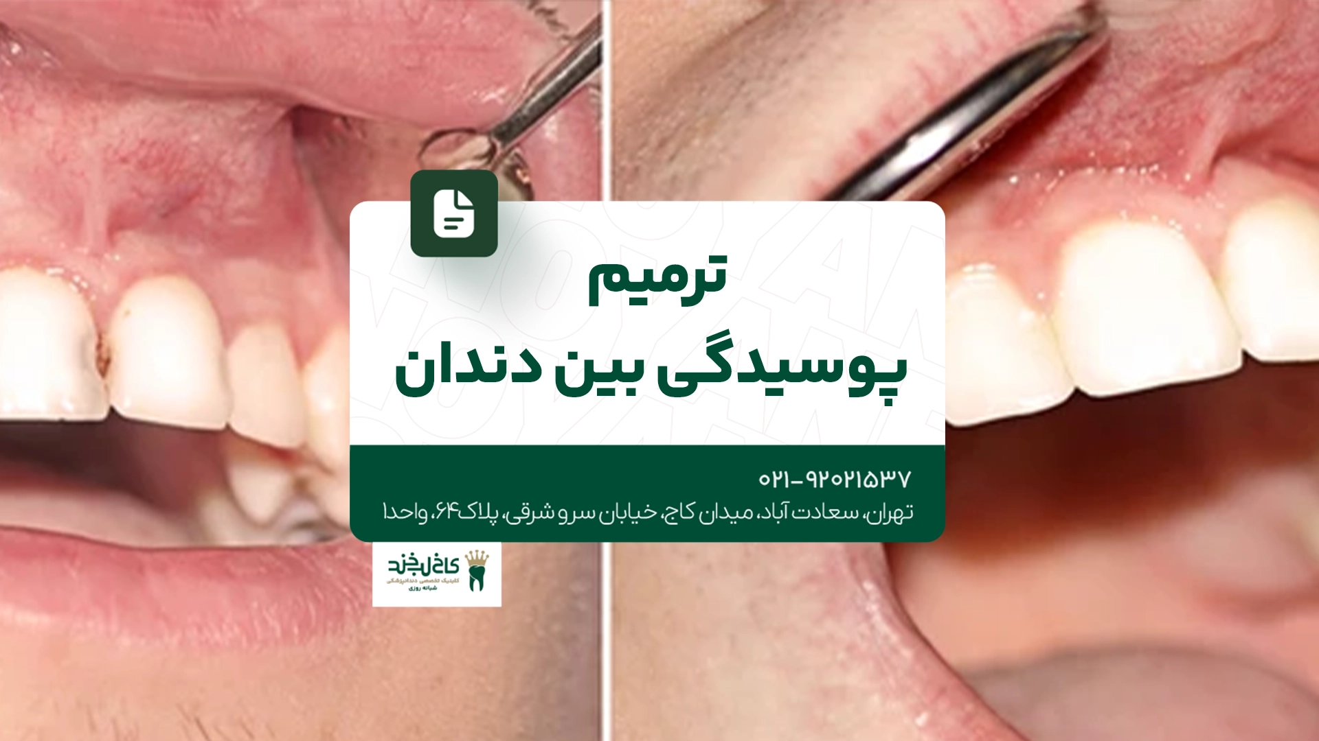 ترمیم پوسیدگی بین دندانی