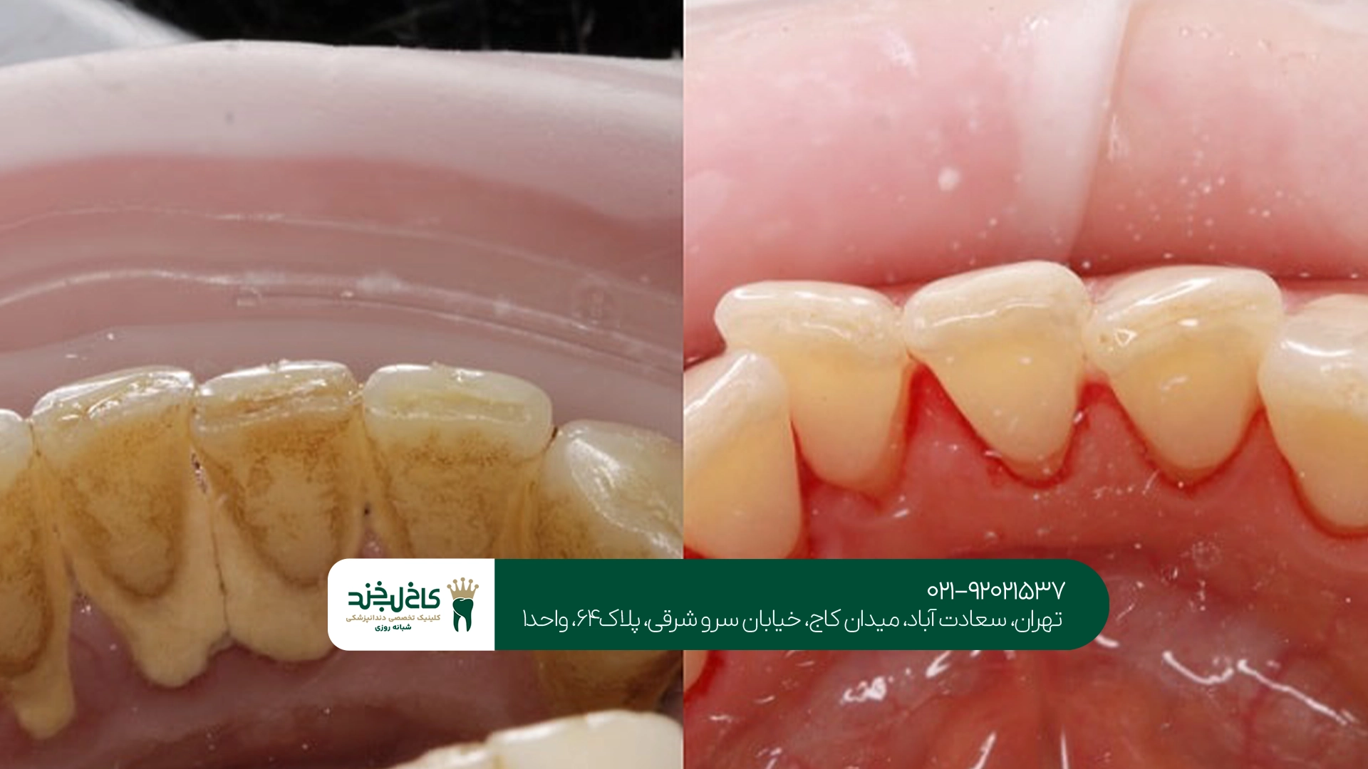 جرمگیری دندان در تهران جرمگیری دندان در تهران