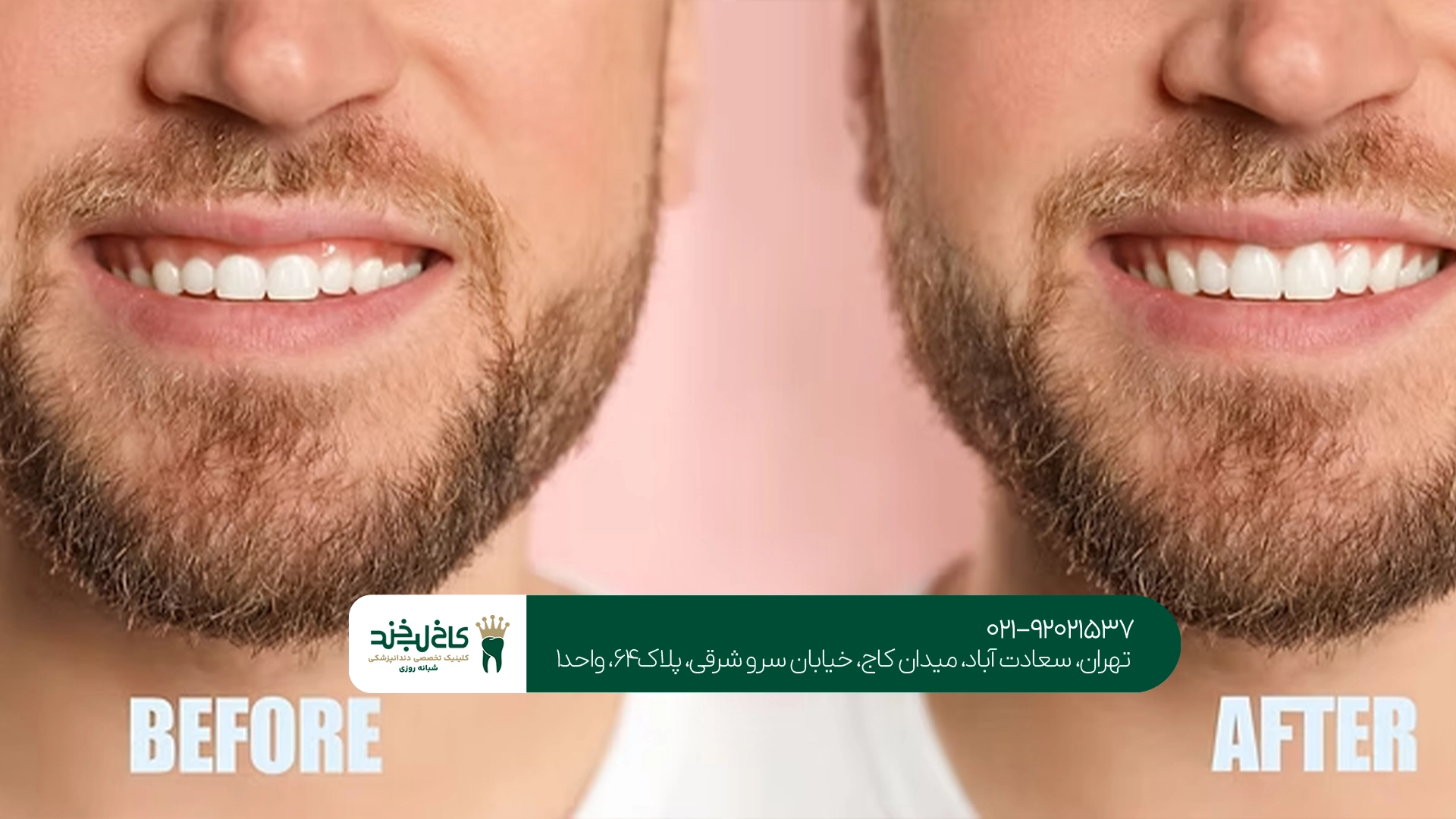 متخصص جراحی افزایش طول تاج دندان