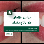 جراحی افزایش طول تاج دندان