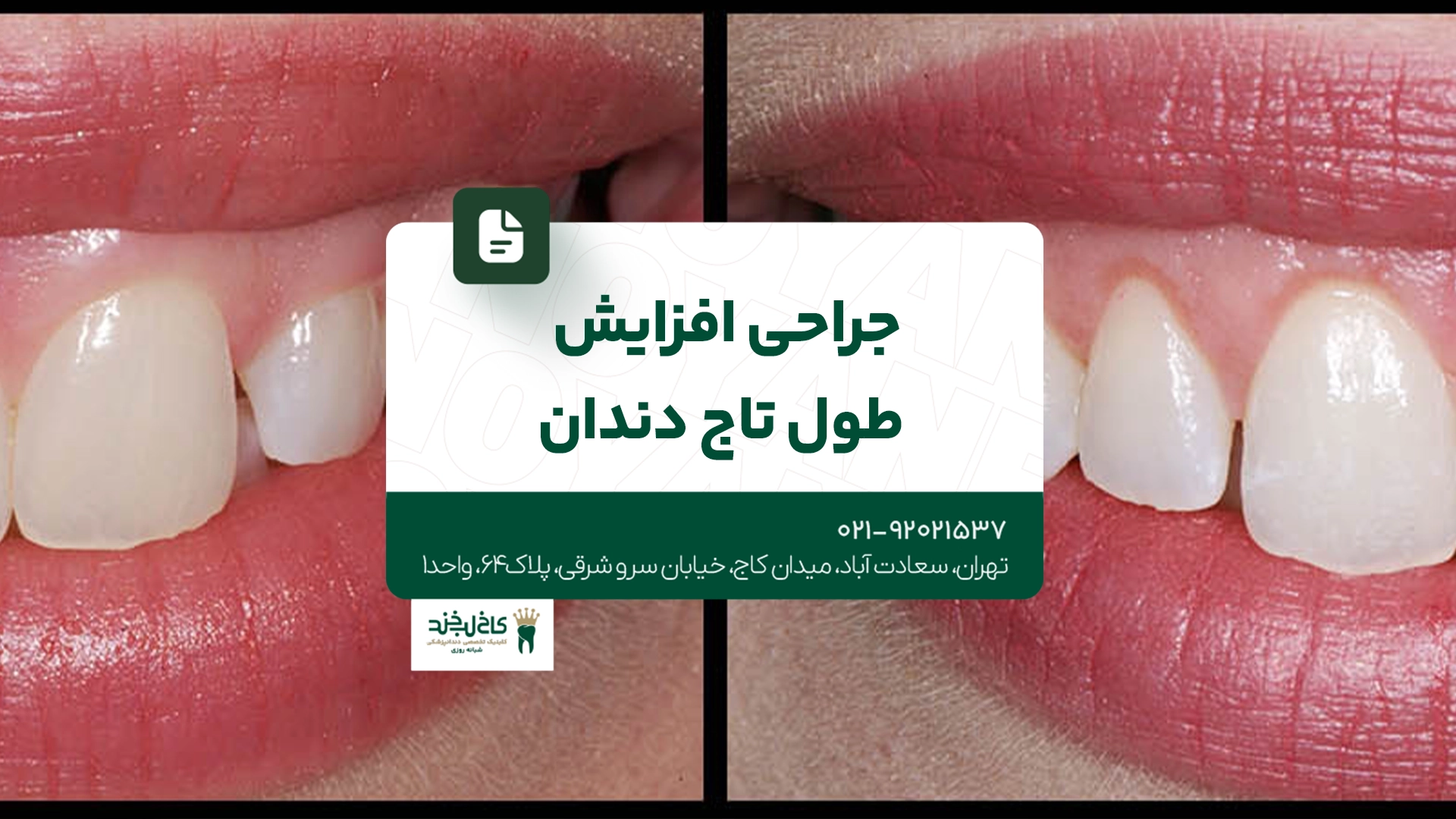 جراحی افزایش طول تاج دندان