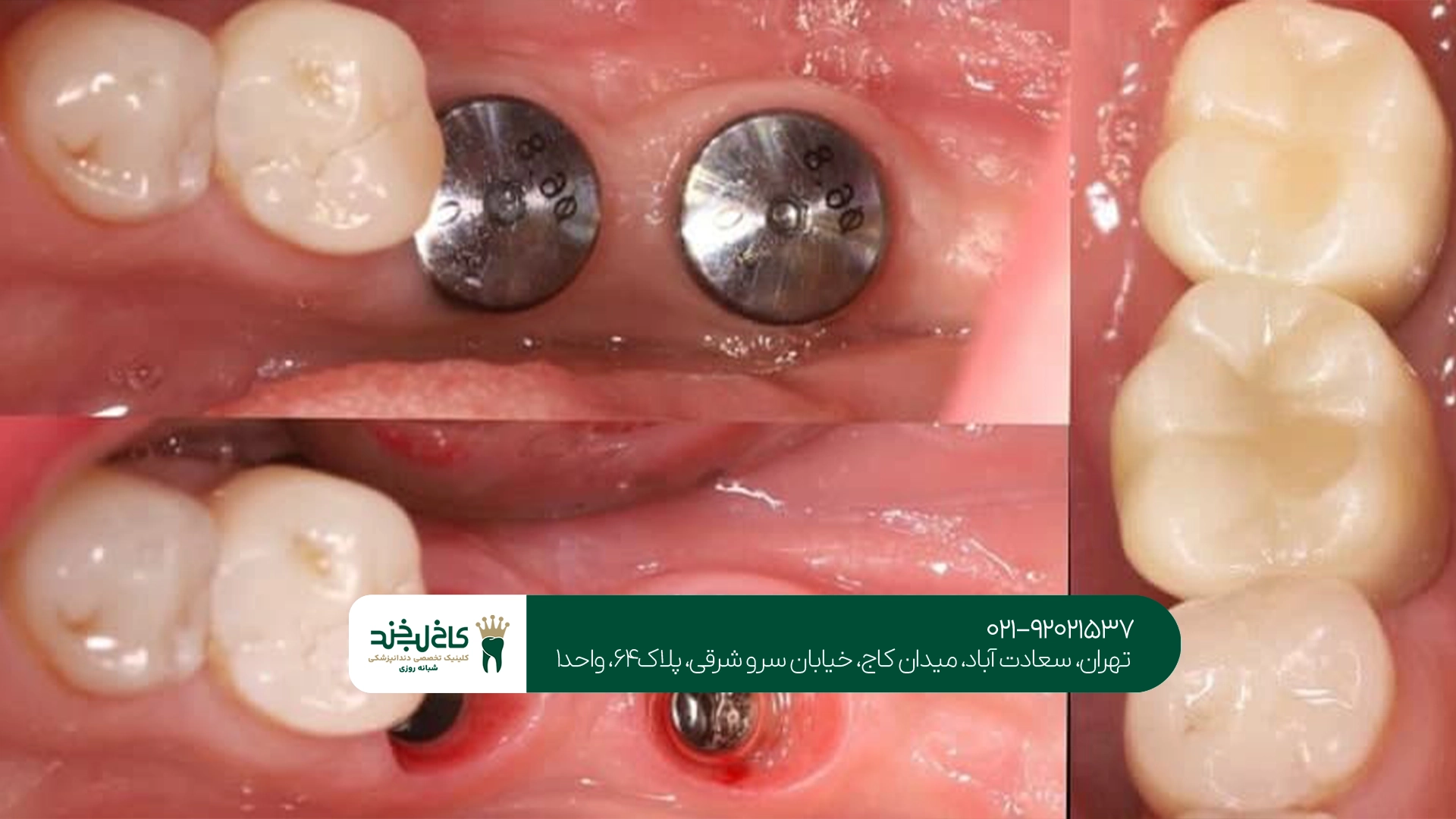 متخصص جراحی ایمپلنت دندان