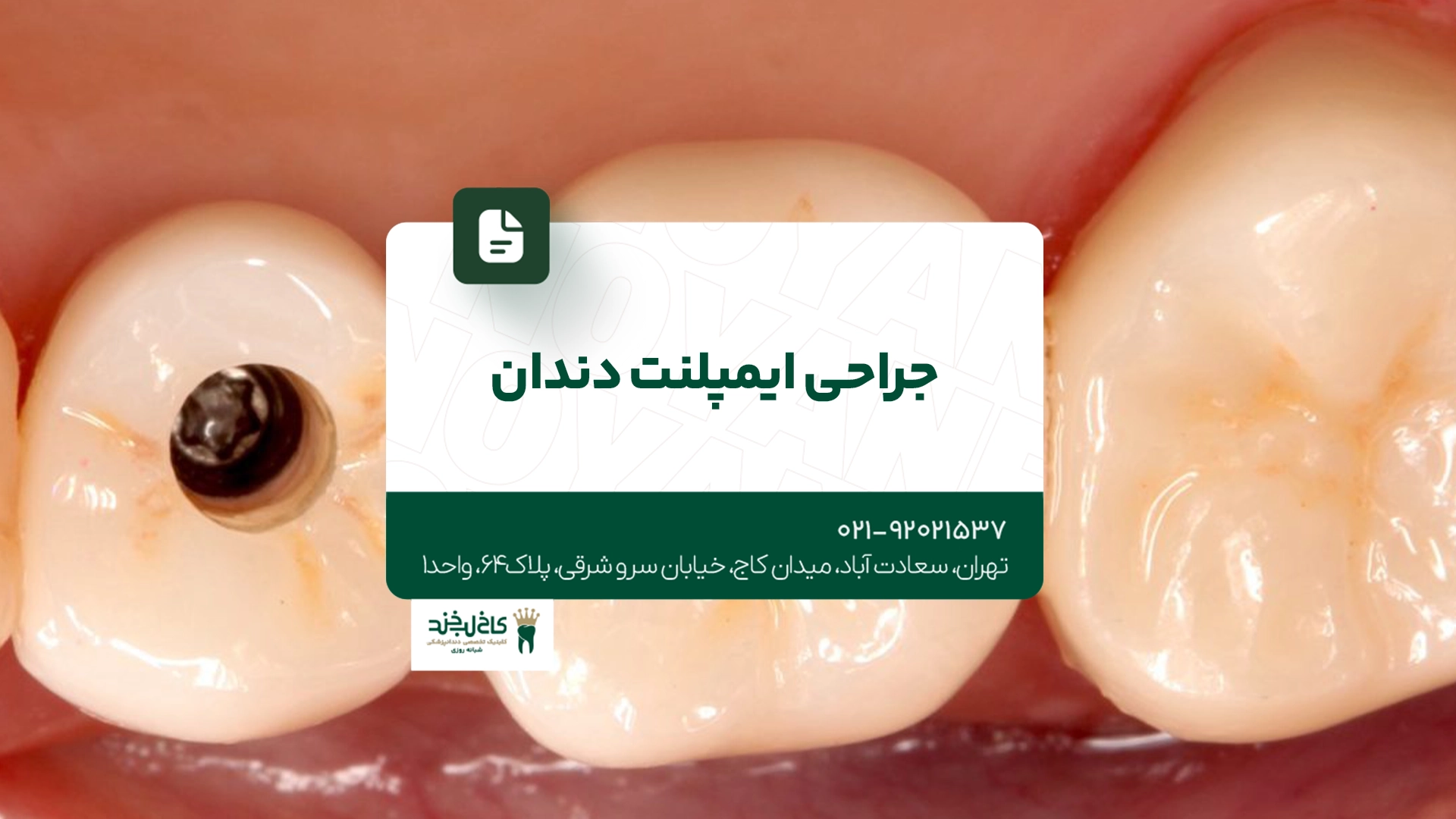 جراحی ایمپلنت دندان