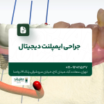 جراحی ایمپلنت دیجیتال