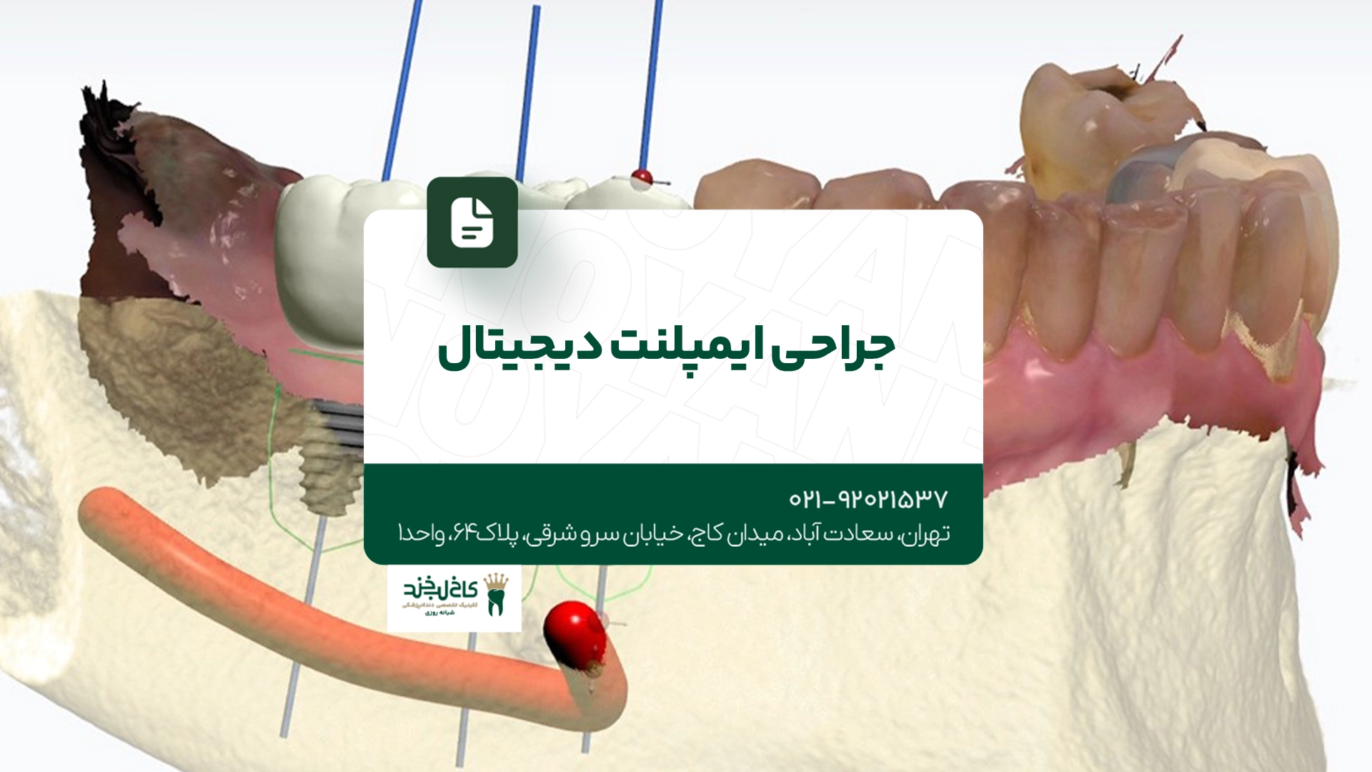 جراحی ایمپلنت دیجیتال