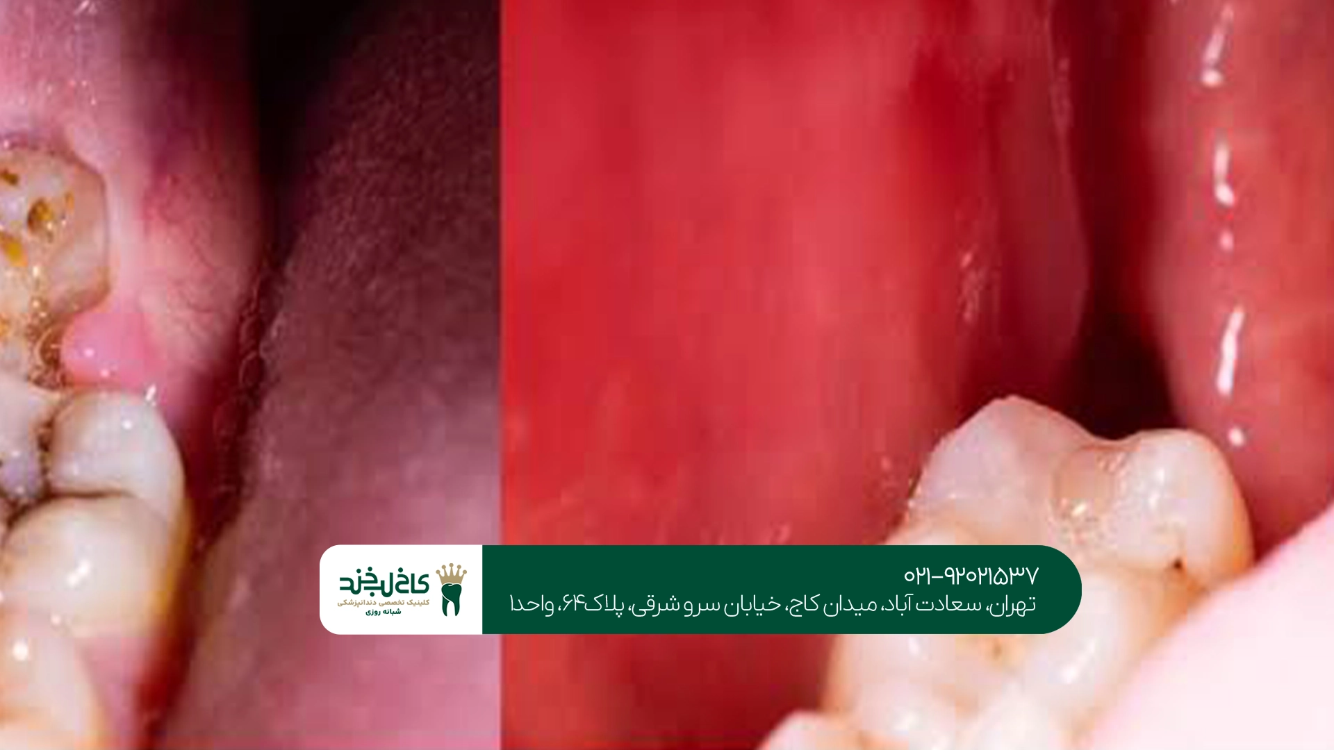 جراحی دندان عقل نهفته سعادت آباد جراحی دندان عقل نهفته سعادت آباد
