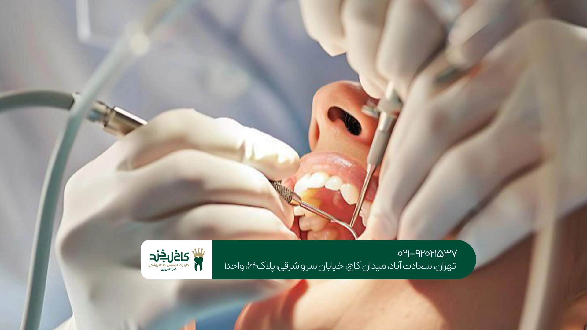 جراحی دندان عقل جراحی دندان عقل
