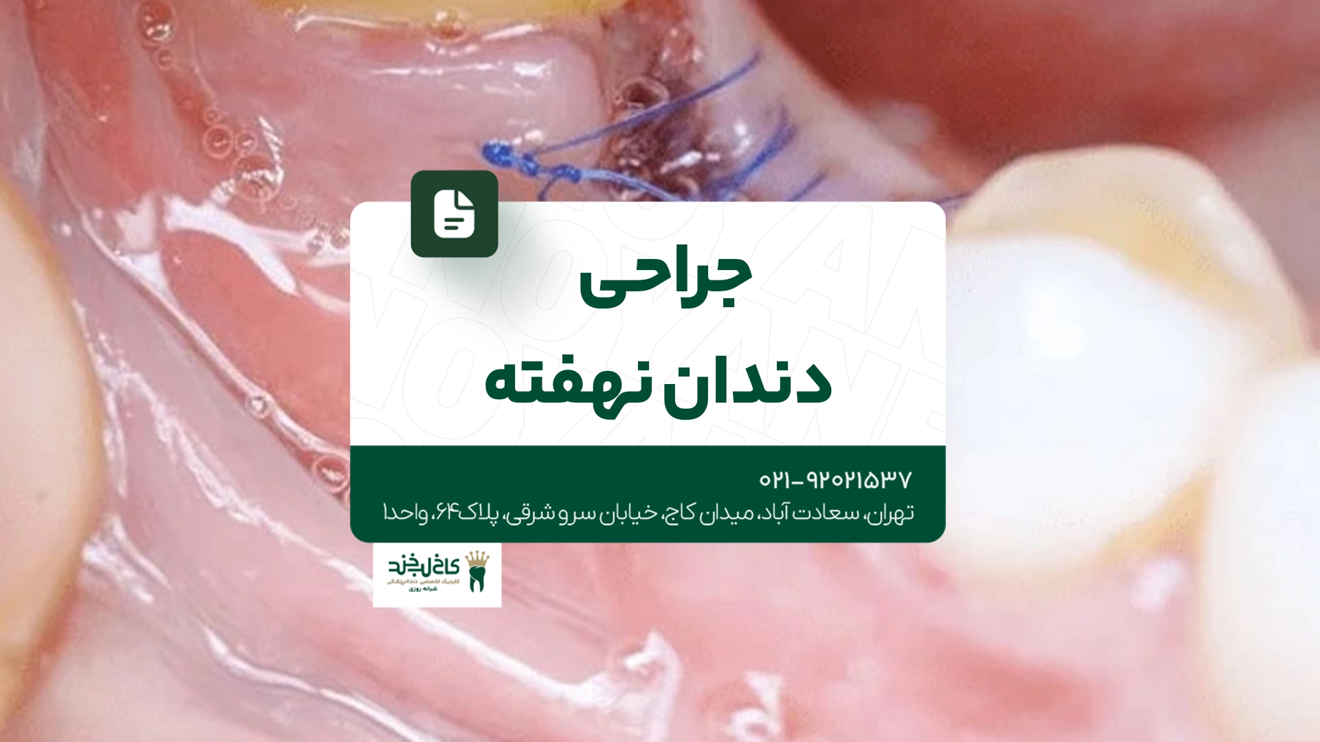 جراحی دندان نهفته