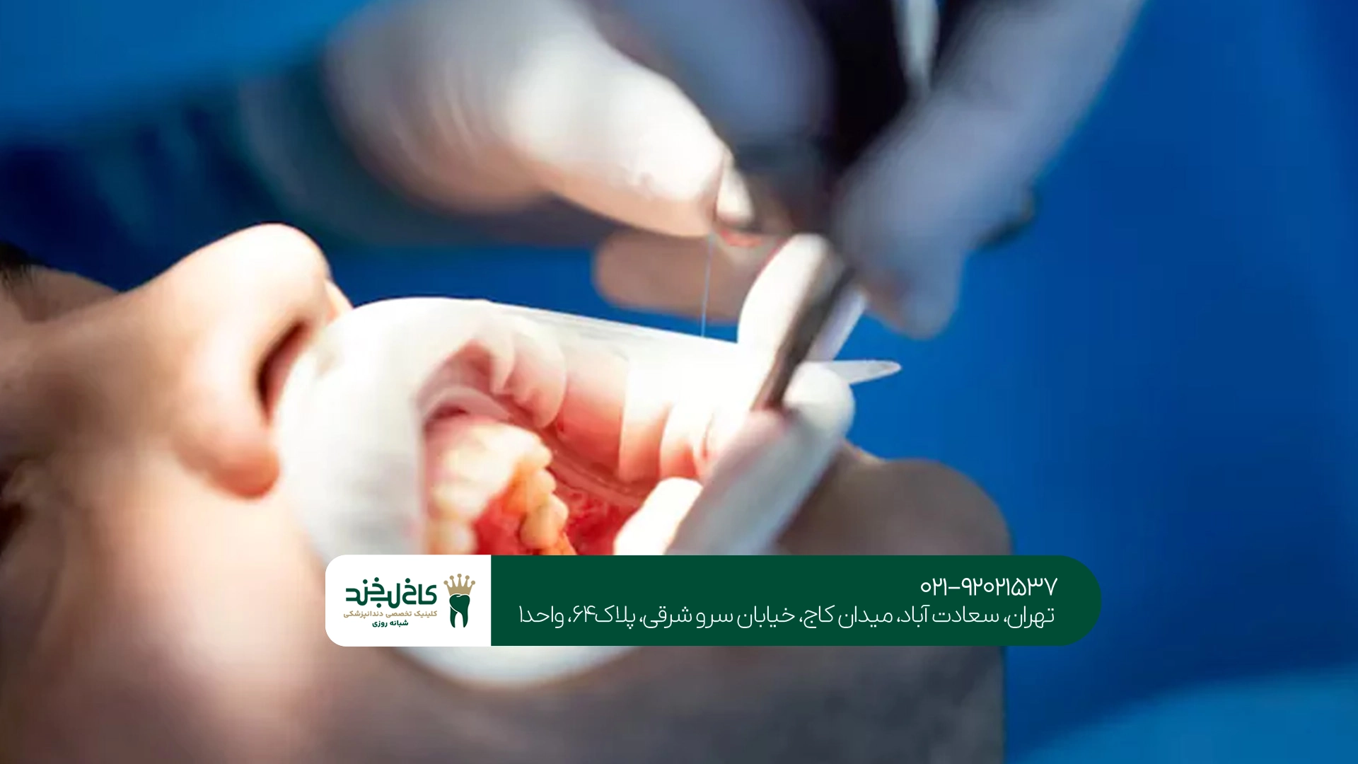 هزینه جراحی ریشه دندان