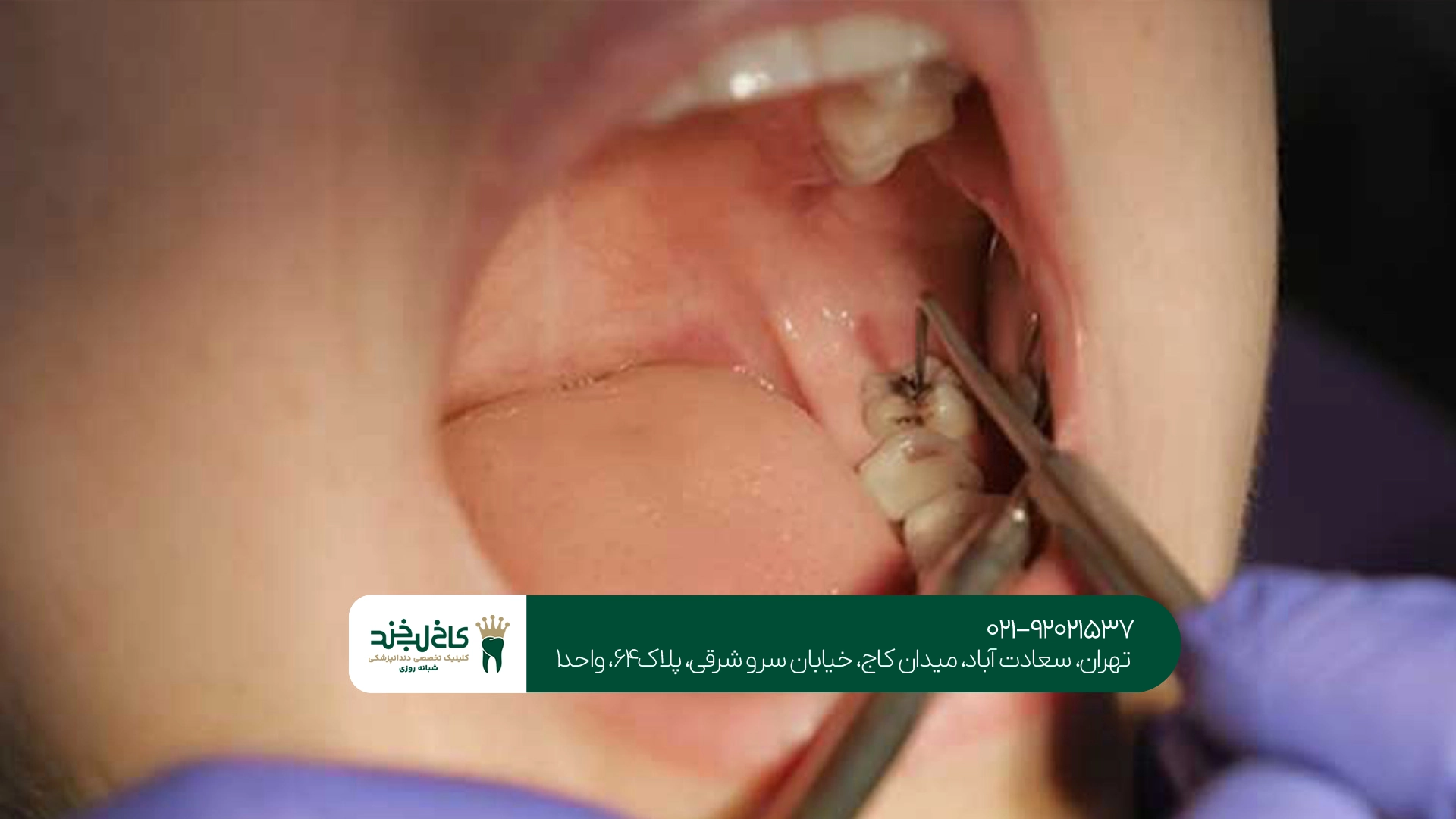 مراقبتهای بعد از جراحی ریشه دندان