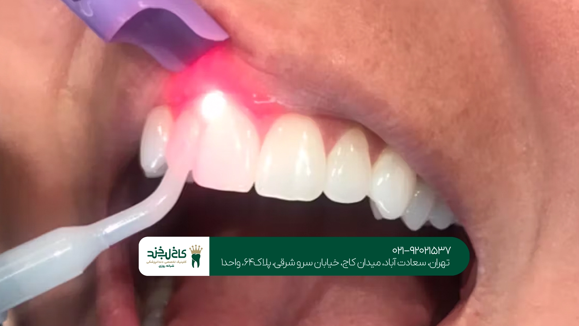 قیمت جراحی لثه با لیزر