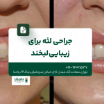 جراحی لثه برای زیبایی لبخند