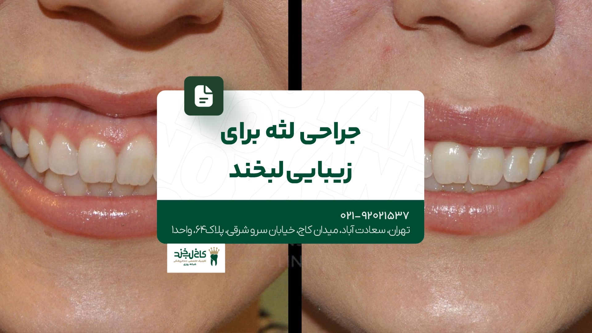 جراحی لثه برای زیبایی لبخند