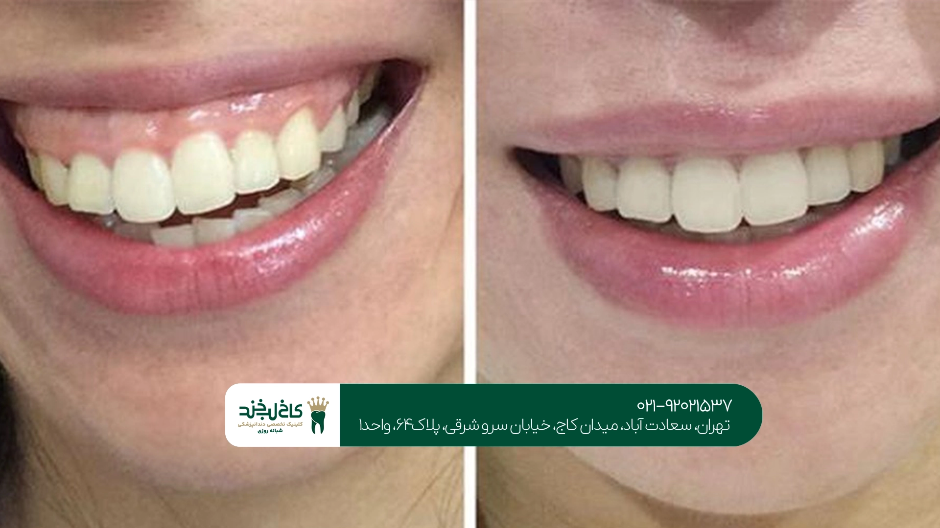جراحی لثه برای زیبایی لبخند در تهران